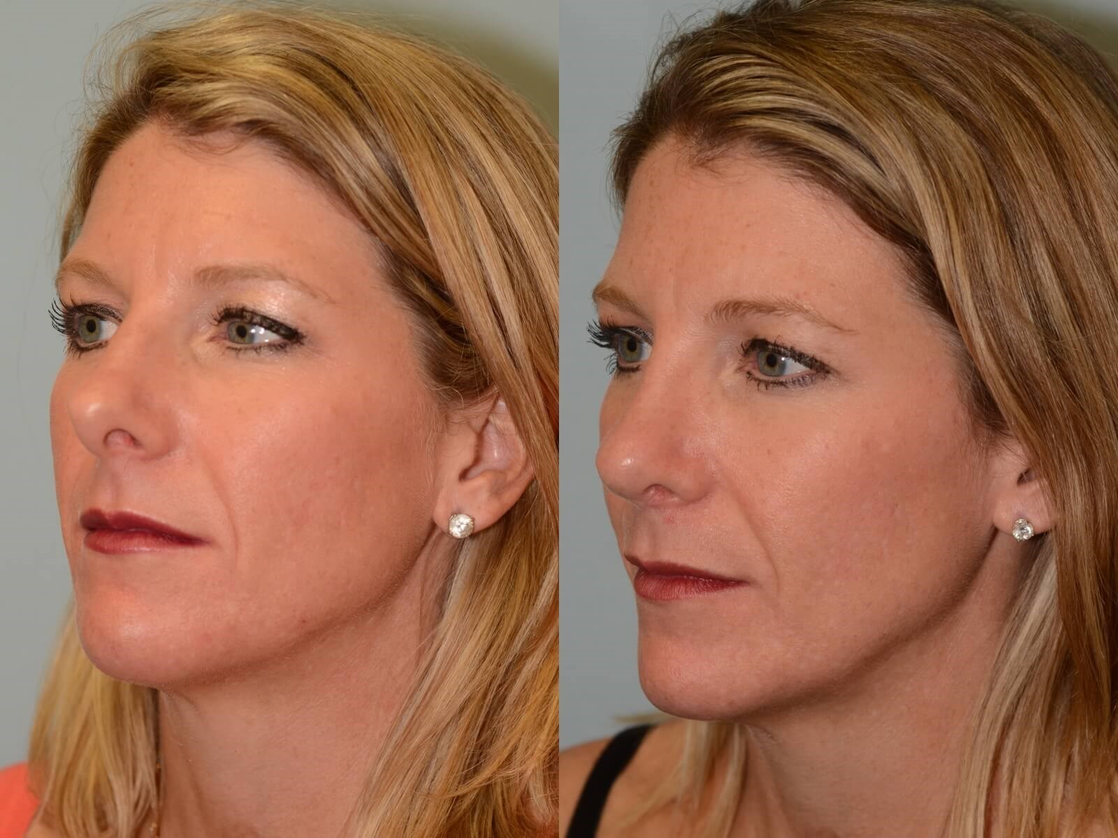 Rhinoplasty Before and After 6 months