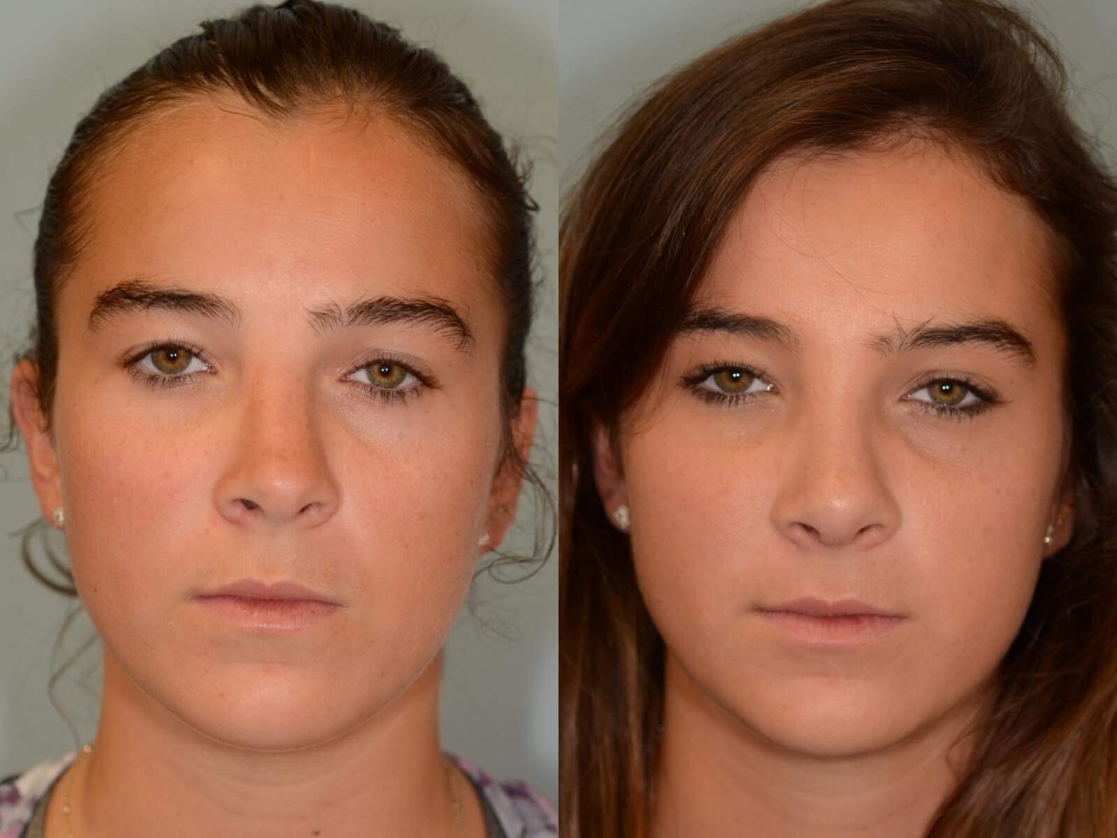 Rhinoplasty Before and After
