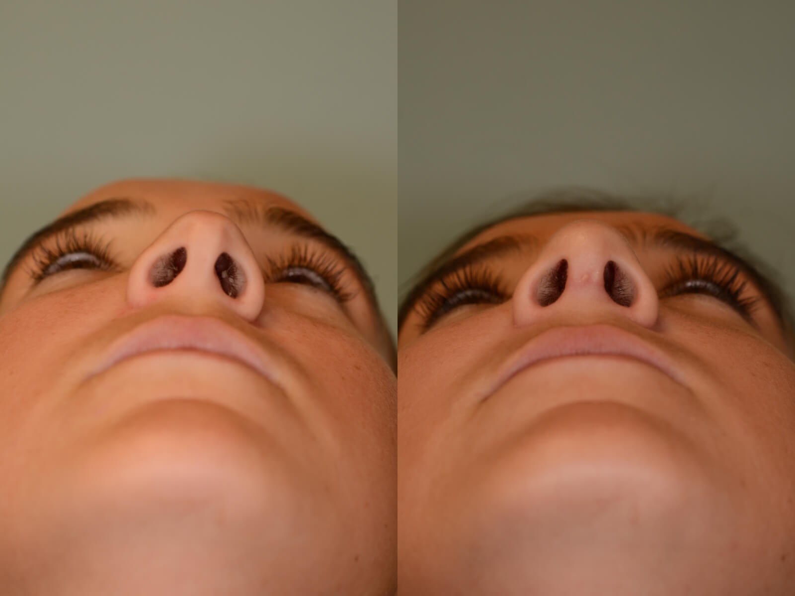 Rhinoplasty Before and After