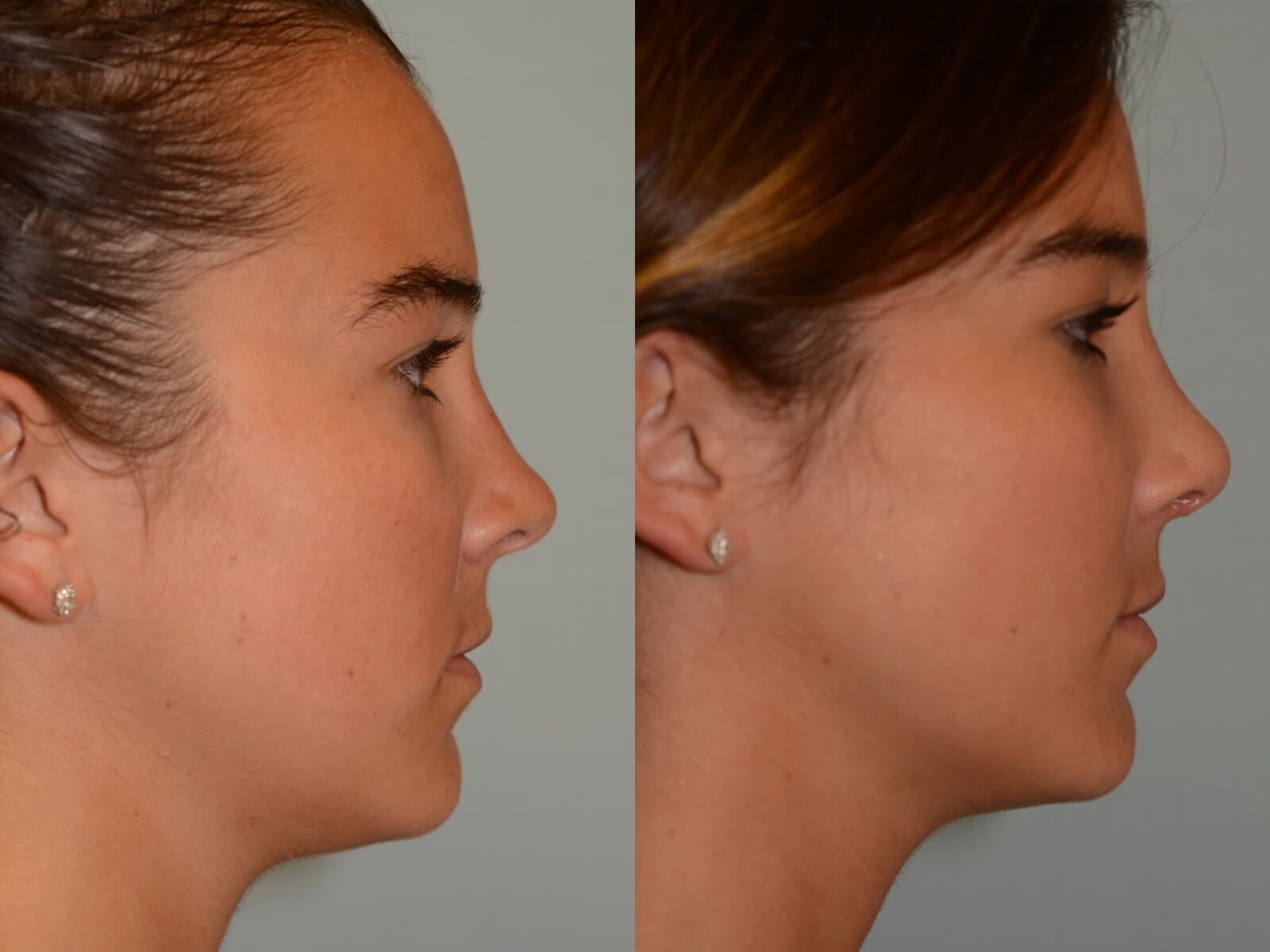 Rhinoplasty Before and After