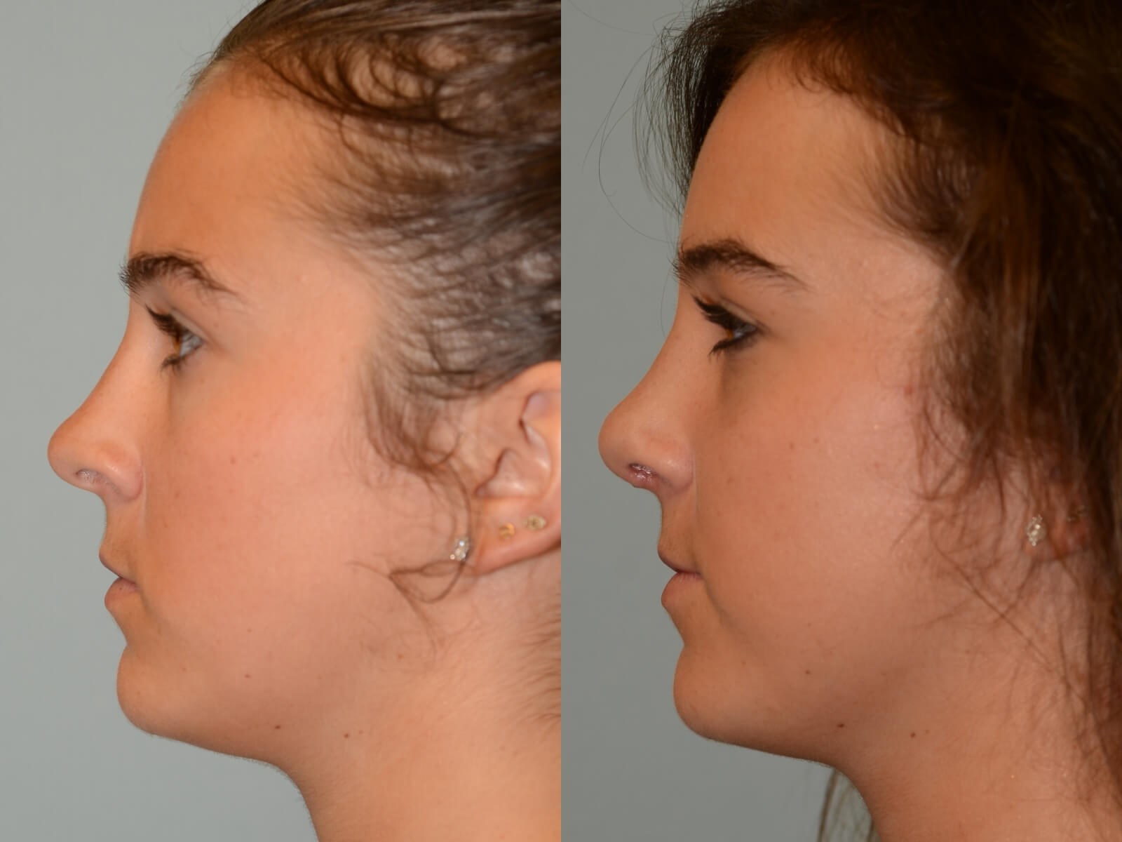 Rhinoplasty Before and After