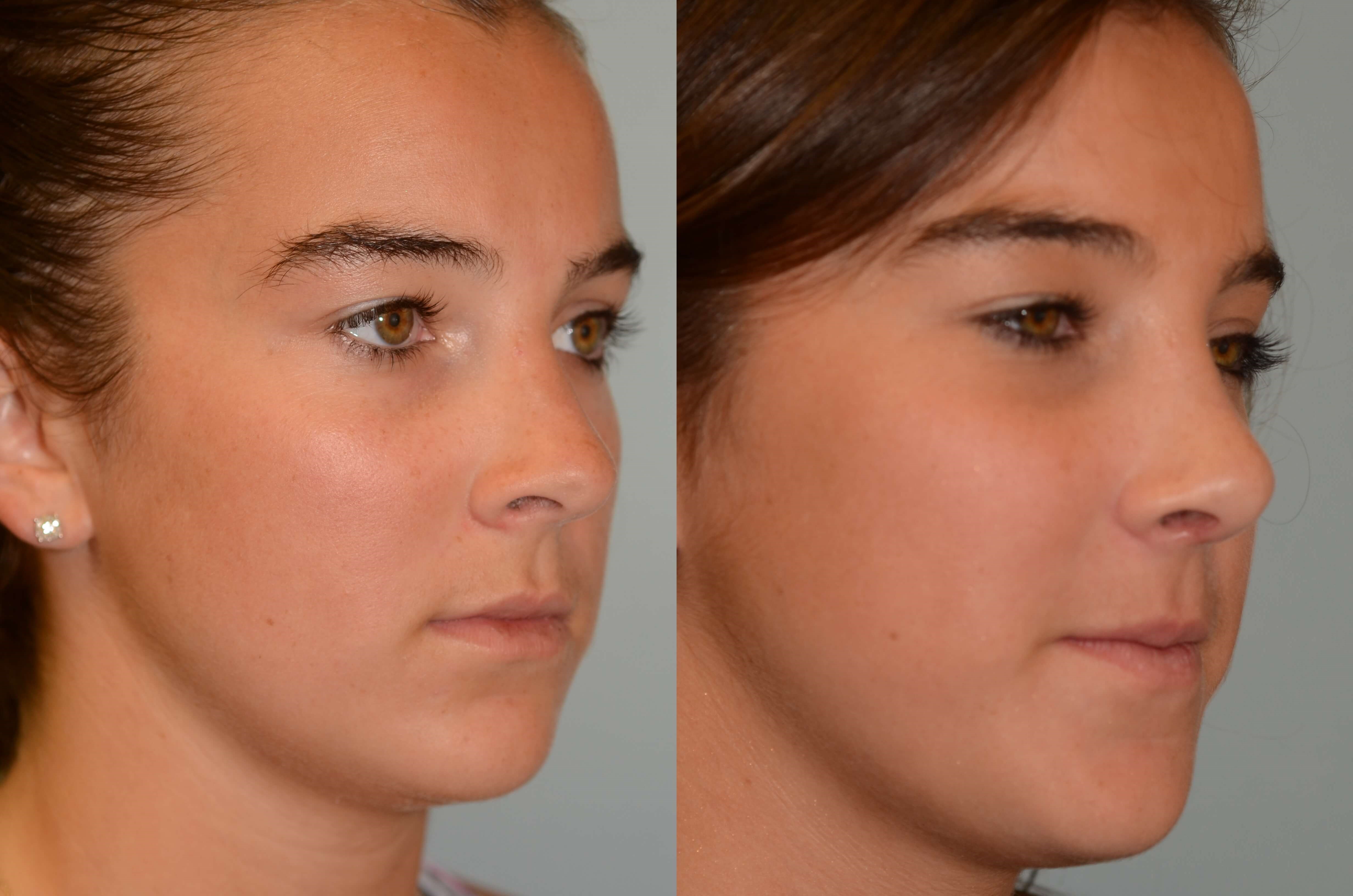 Rhinoplasty Before and After