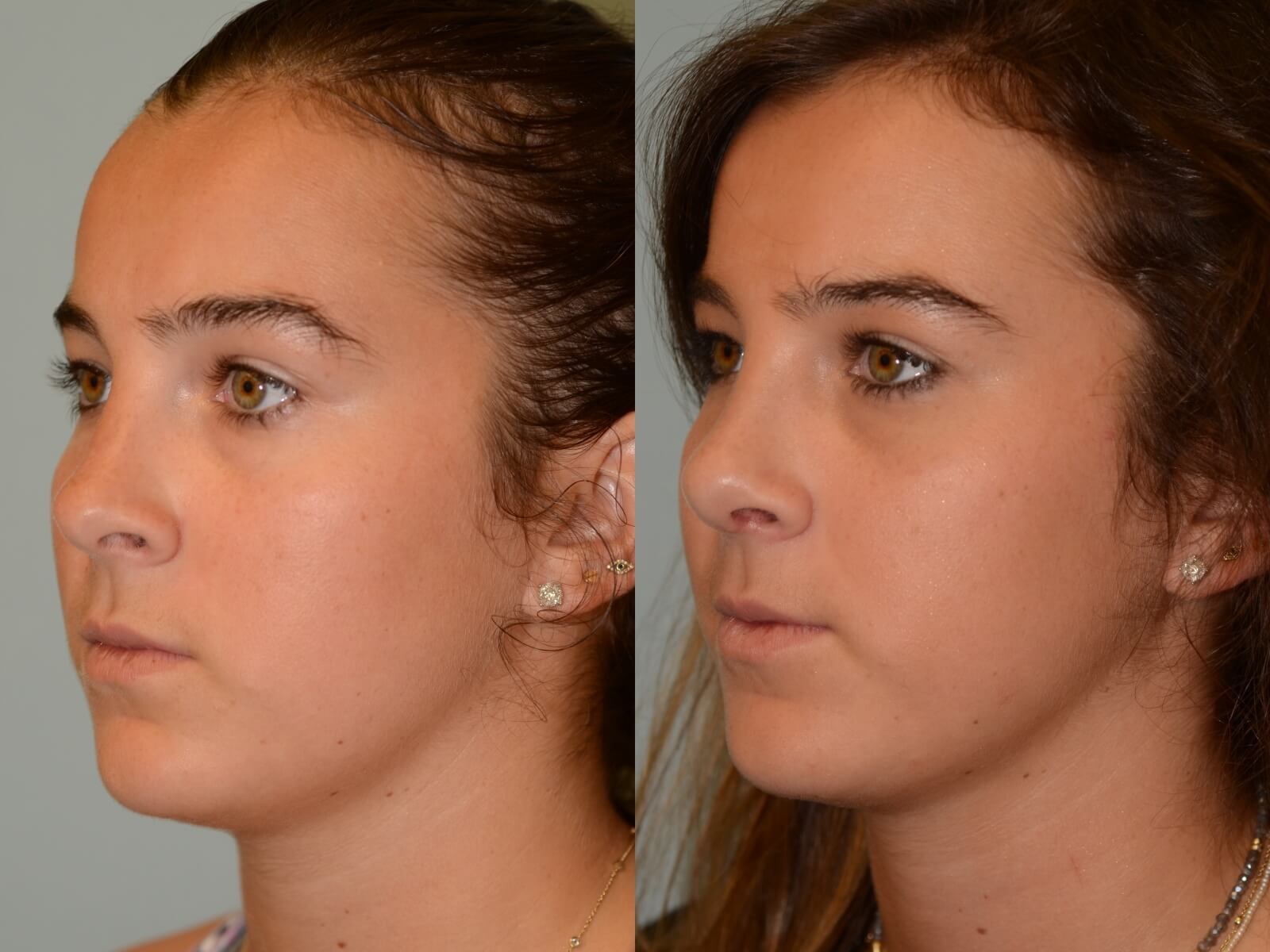 Rhinoplasty Before and After