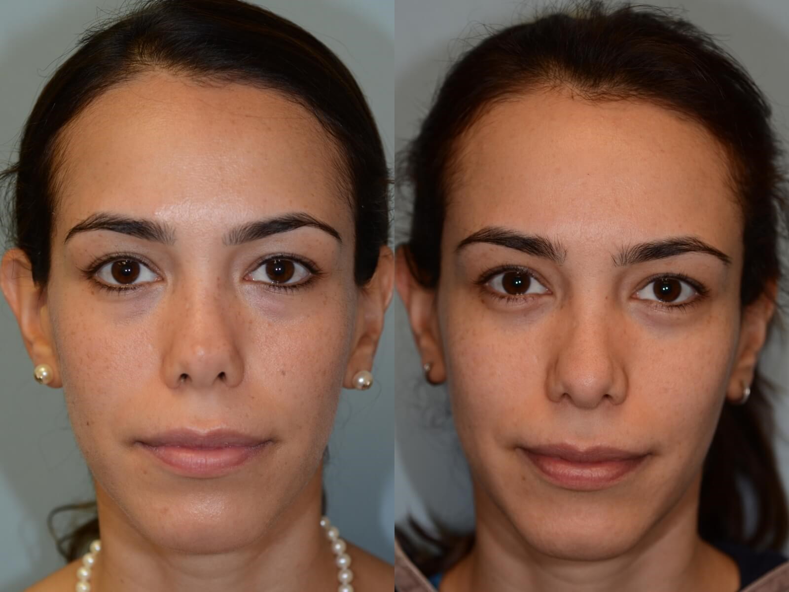 Rhinoplasty Before and After