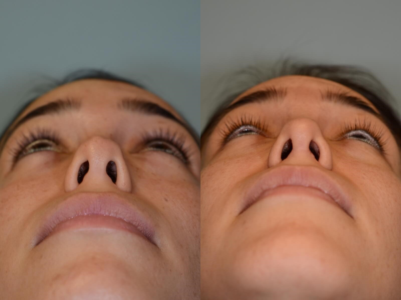 Rhinoplasty Before and After