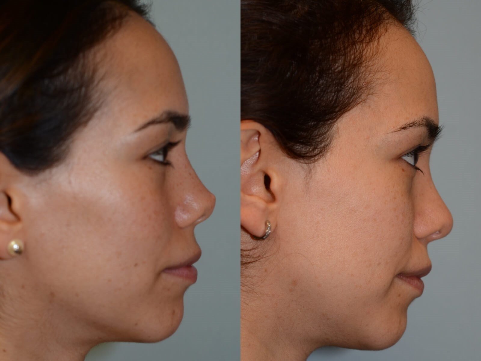 Rhinoplasty Before and After
