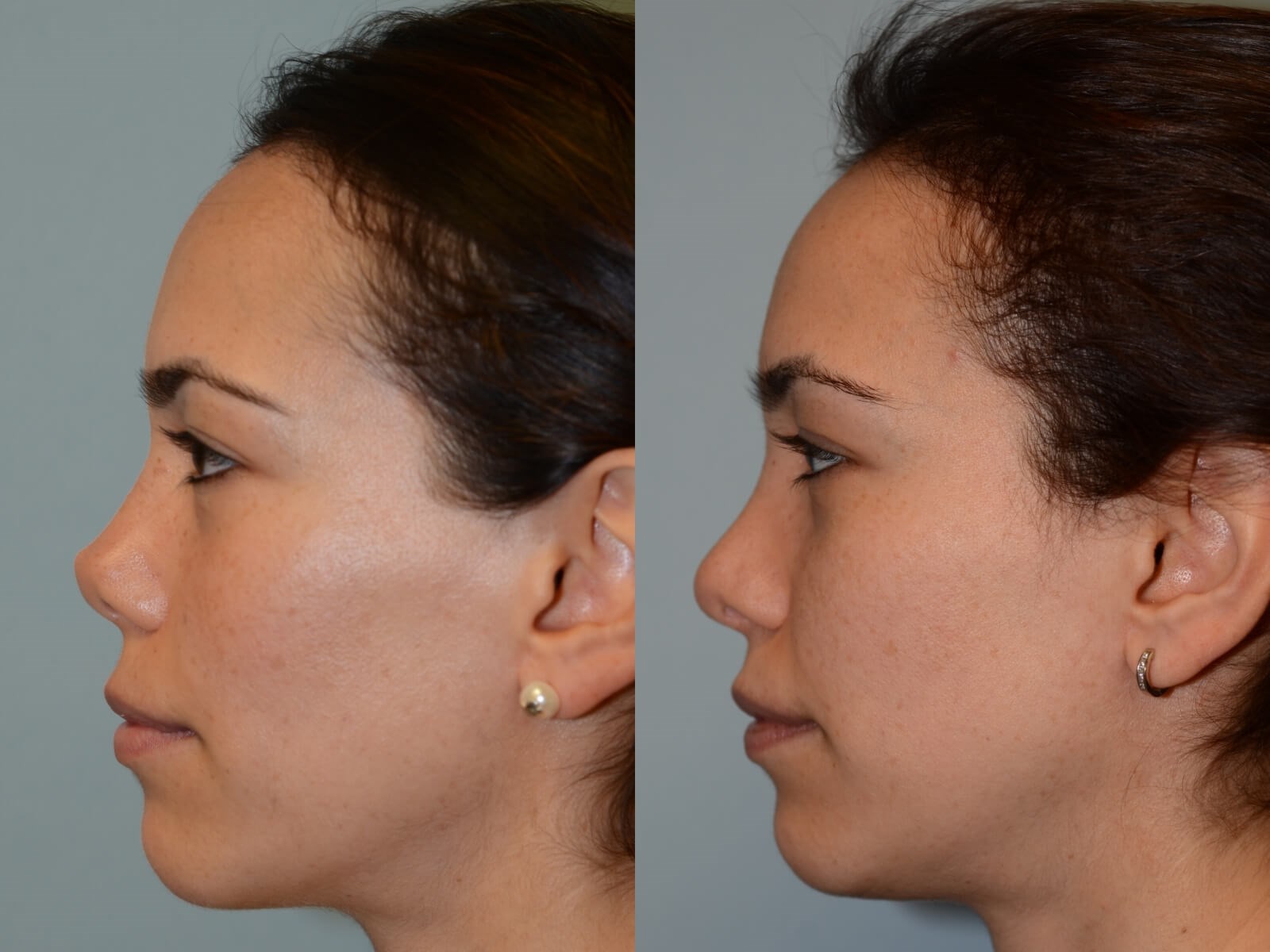 Rhinoplasty Before and After