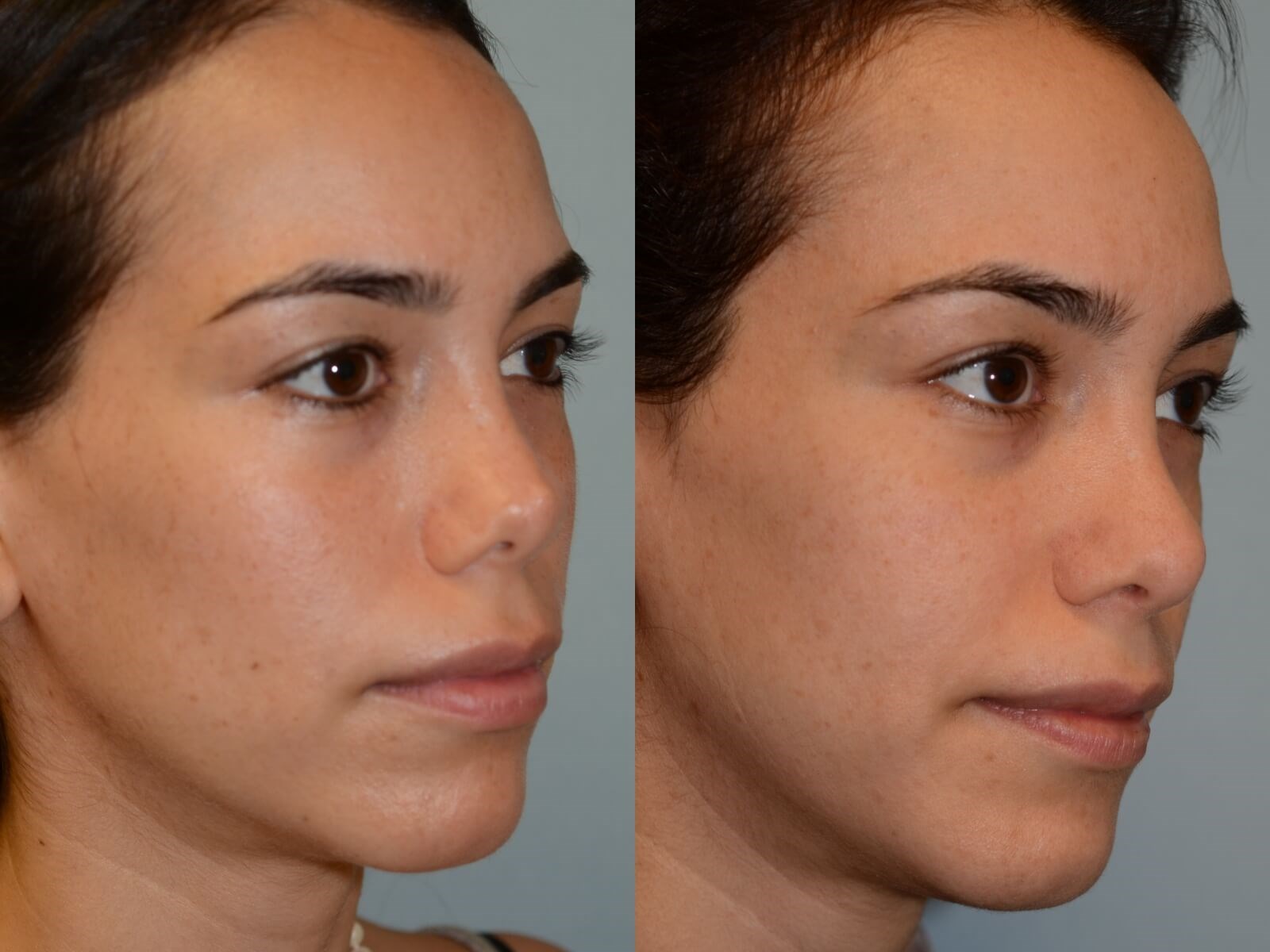 Rhinoplasty Before and After