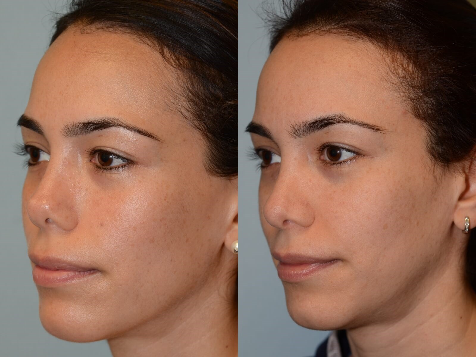 Rhinoplasty Before and After