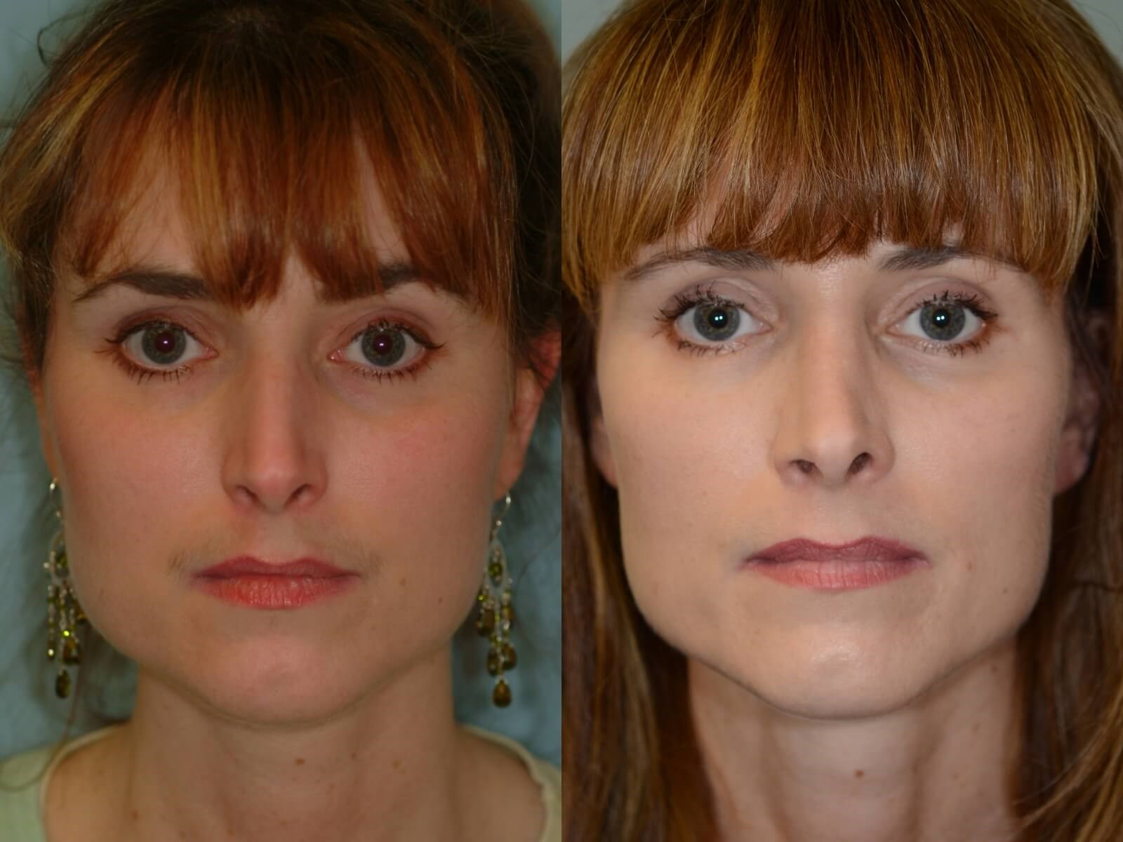Rhinoplasty Before and After