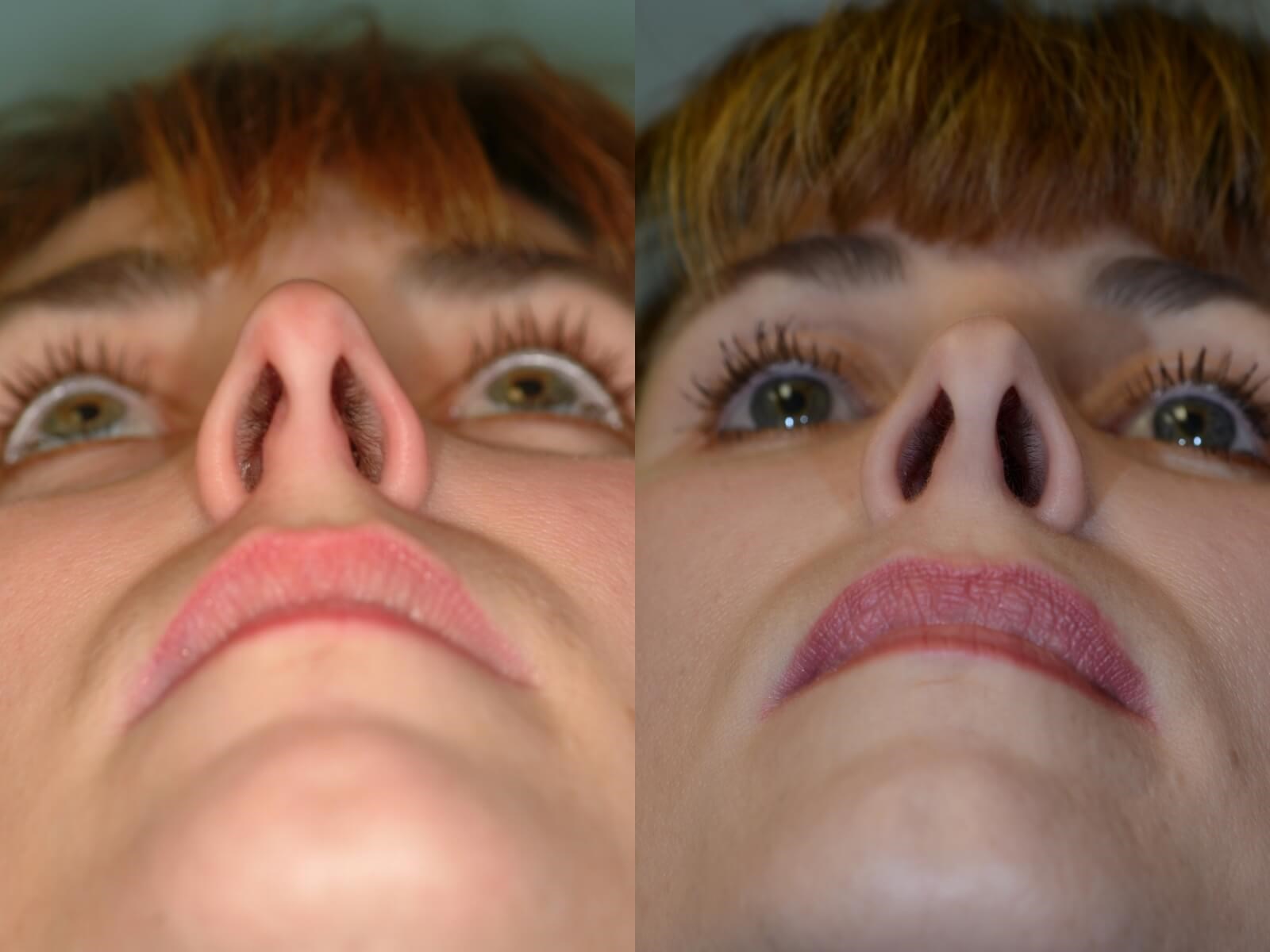 Rhinoplasty Before and After