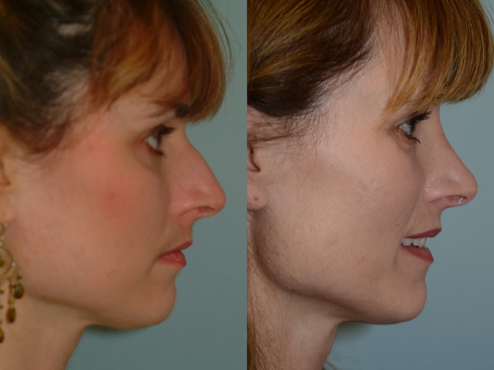 Rhinoplasty Before and After