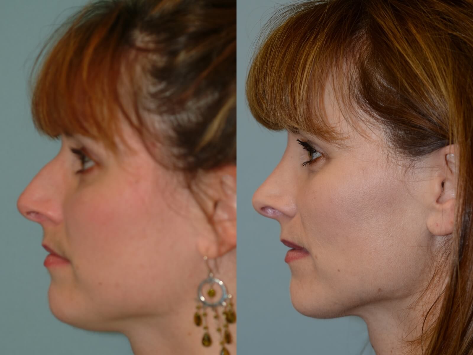 Rhinoplasty Before and After