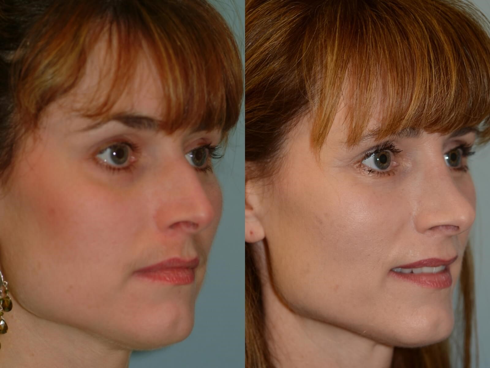 Rhinoplasty Before and After