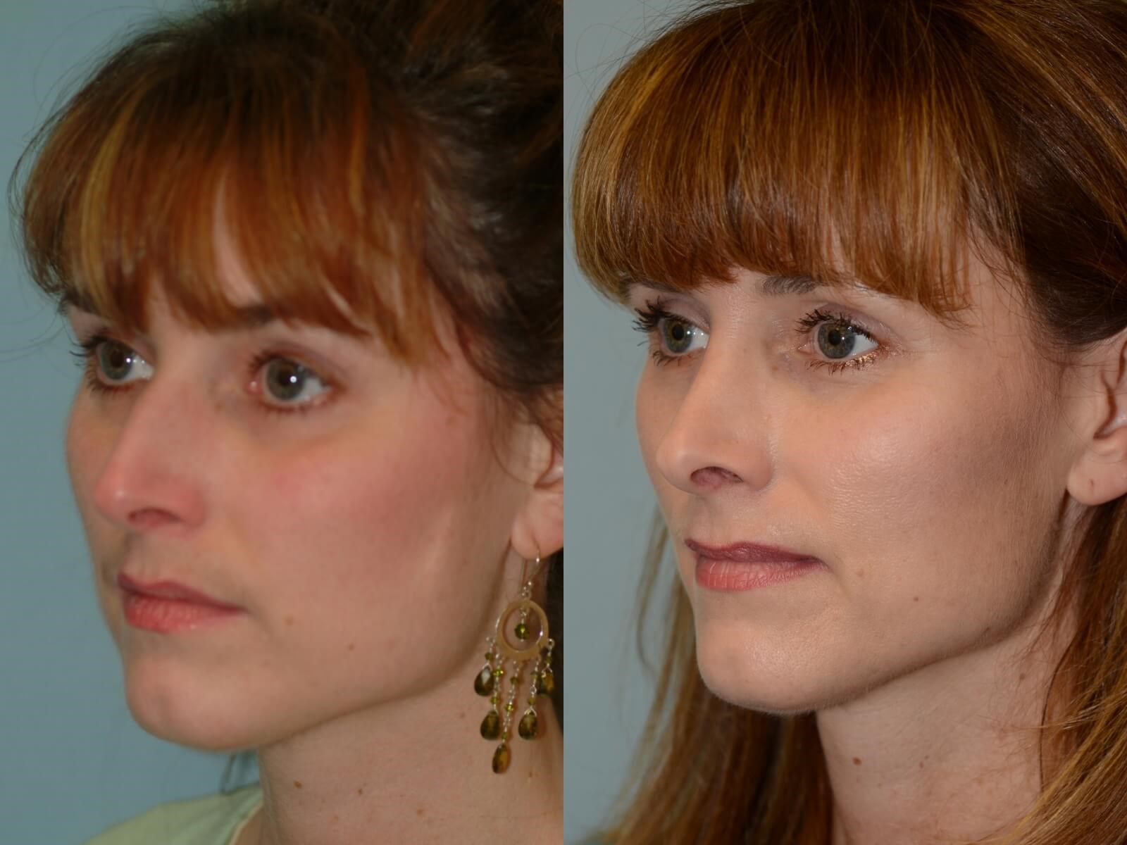 Rhinoplasty Before and After