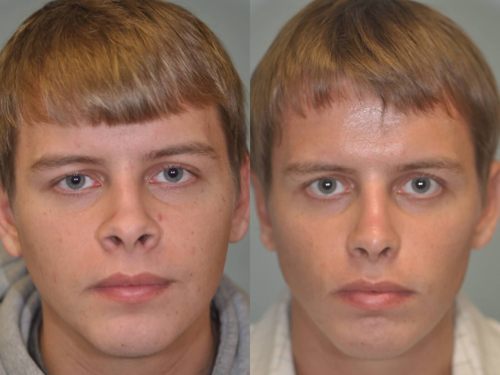 Rhinoplasty Before and After