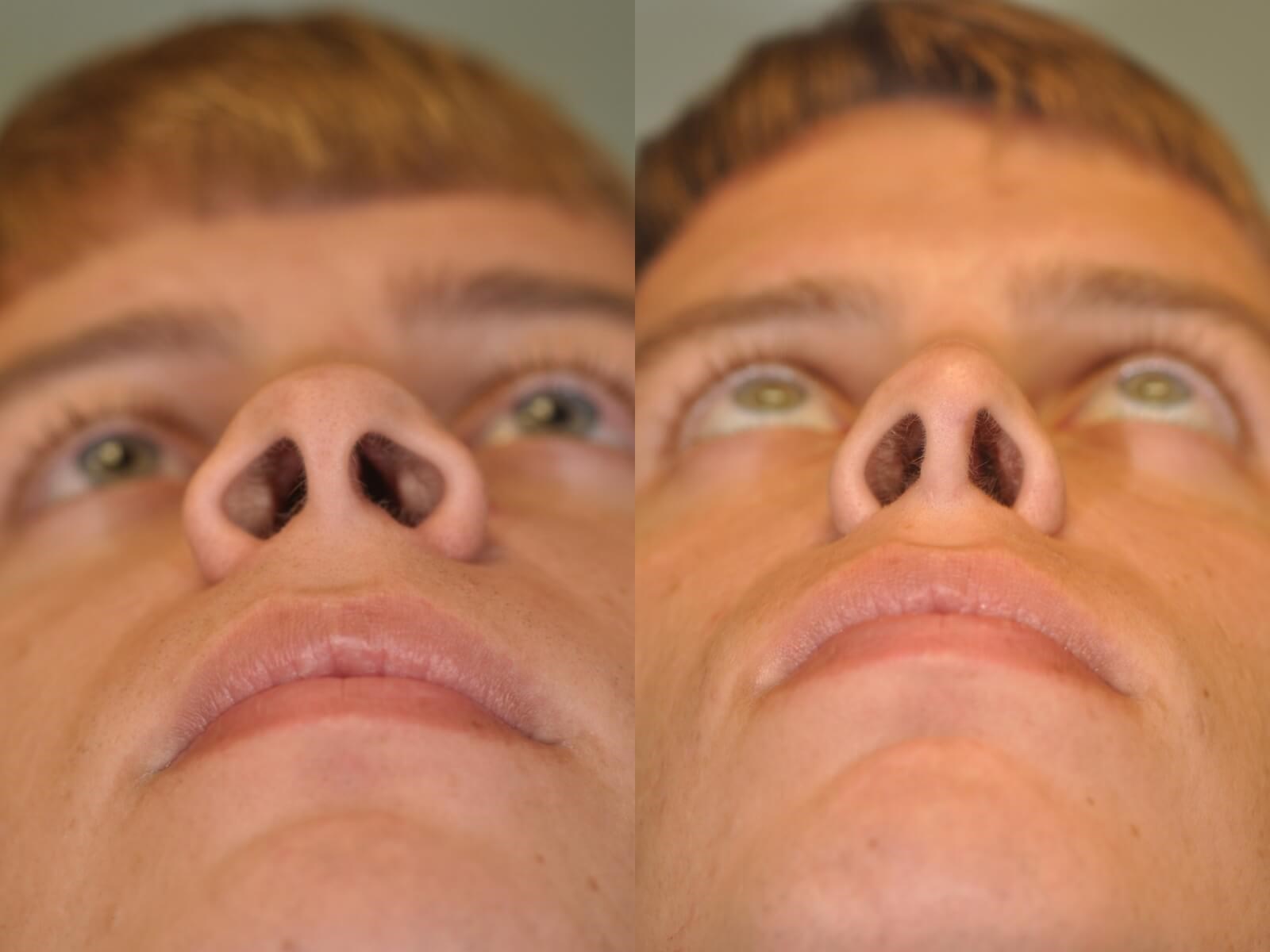 Rhinoplasty Before and After