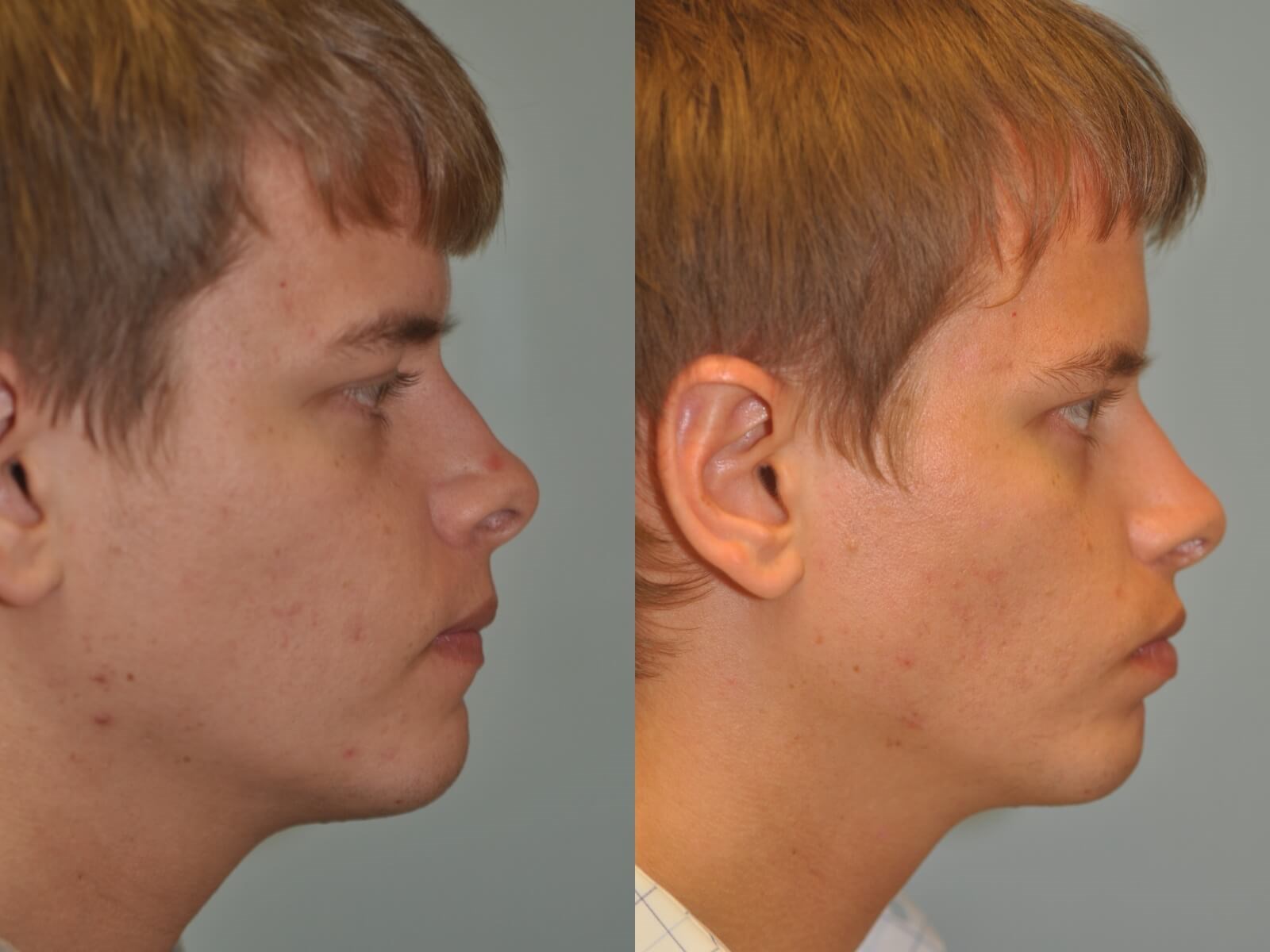 Rhinoplasty Before and After