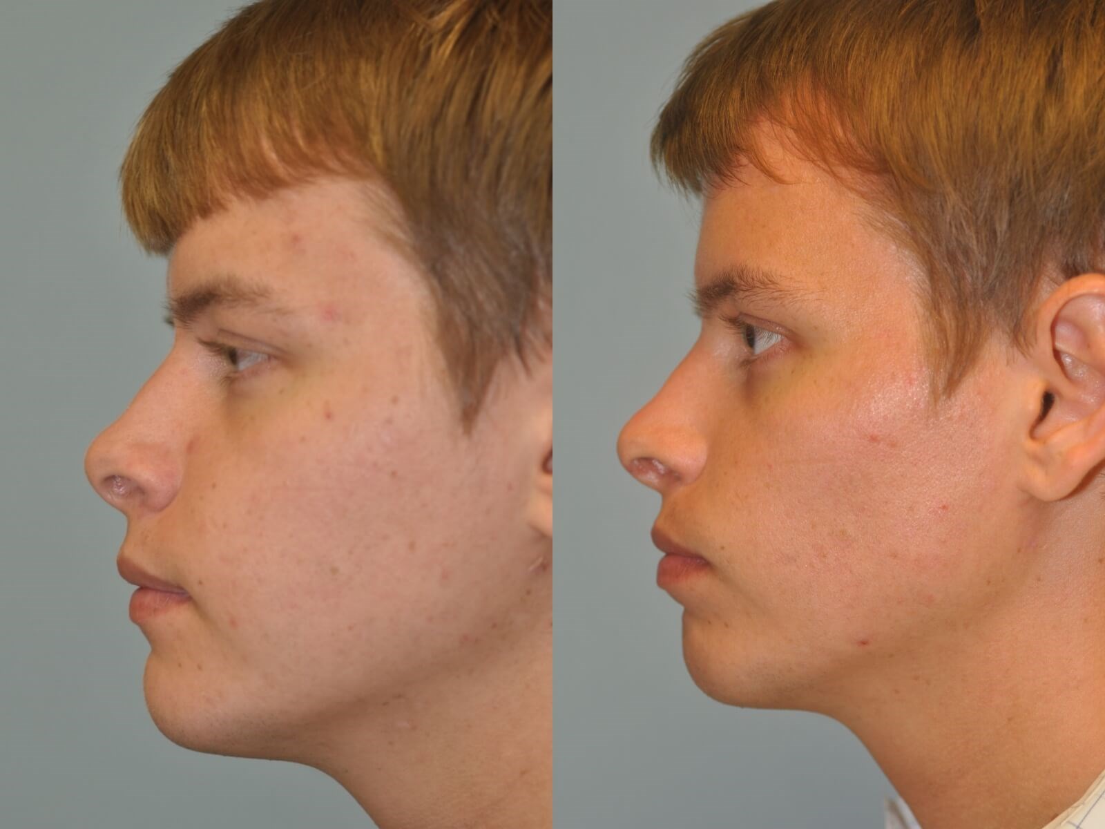 Rhinoplasty Before and After
