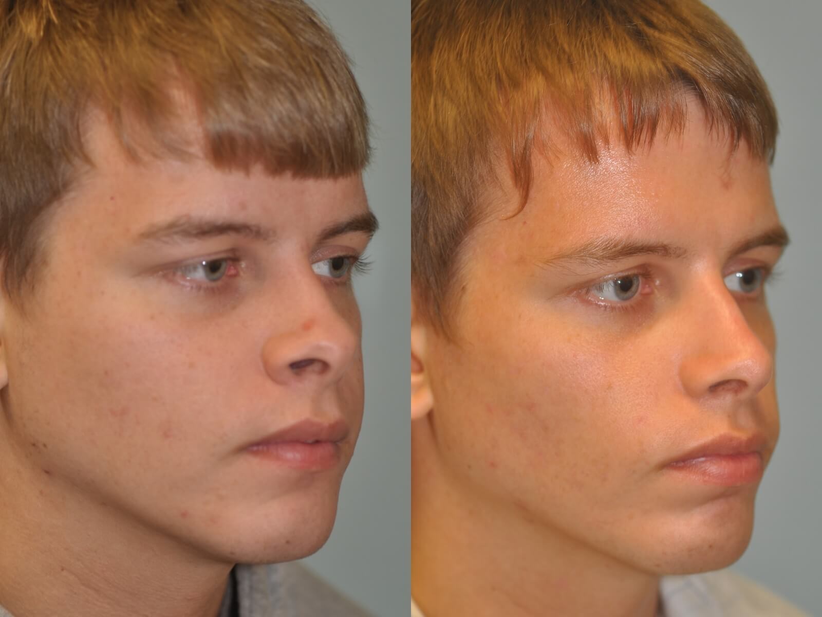 Rhinoplasty Before and After