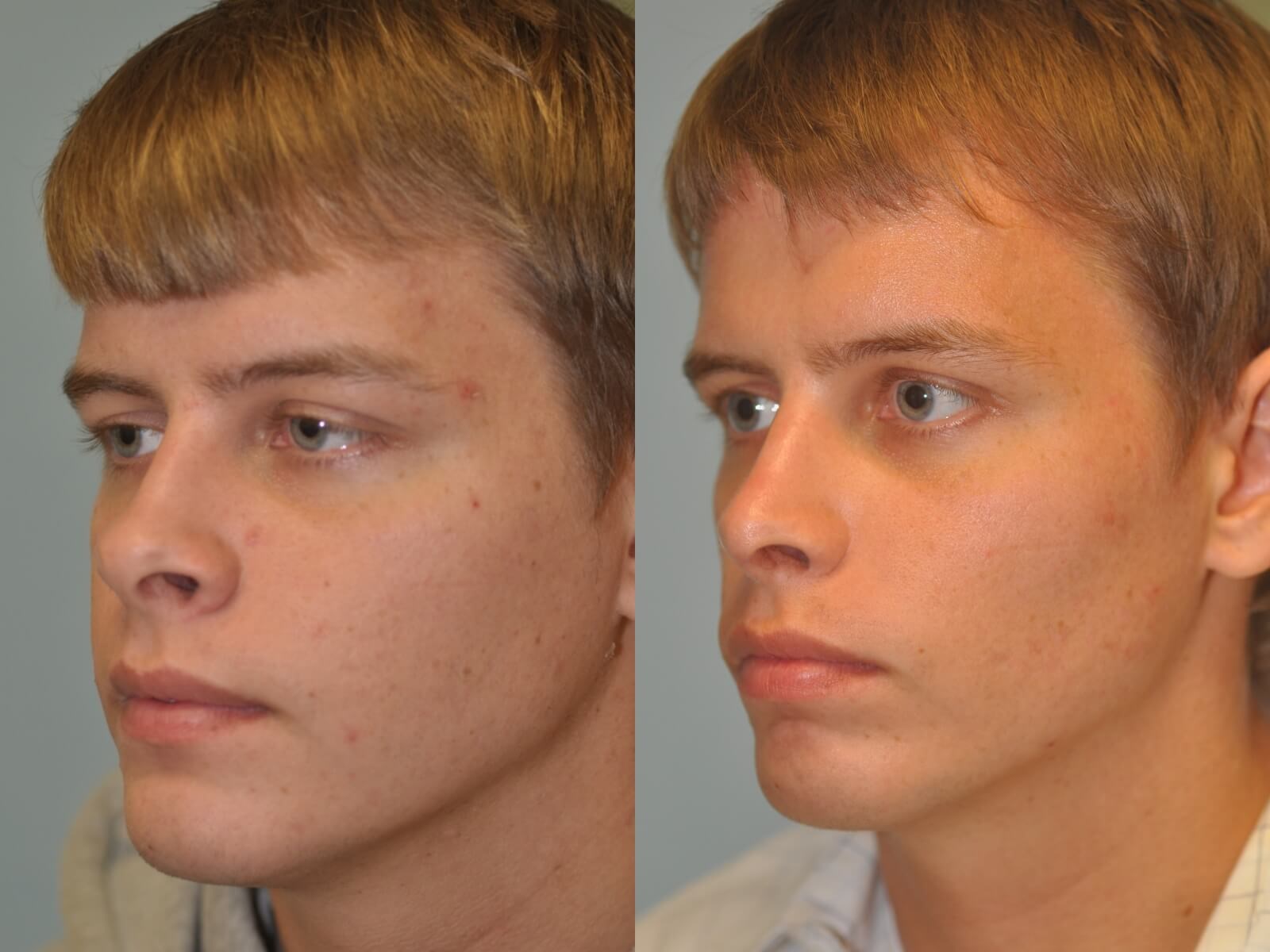 Rhinoplasty Before and After