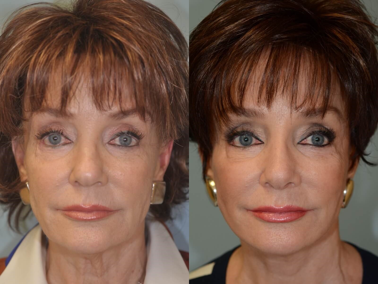 Subtle Natural Rhinoplasty in Houston