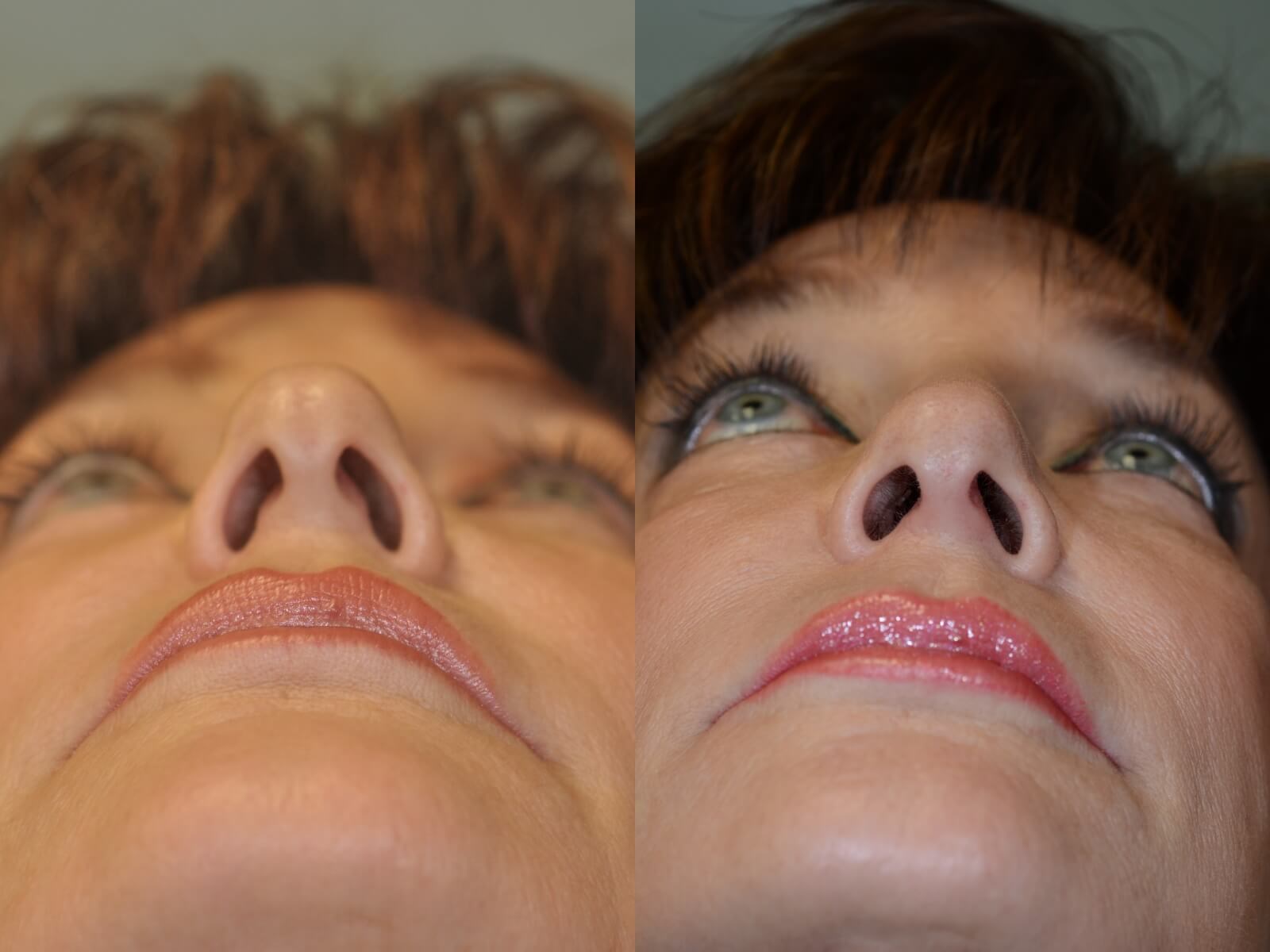 Rhinoplasty Before and After