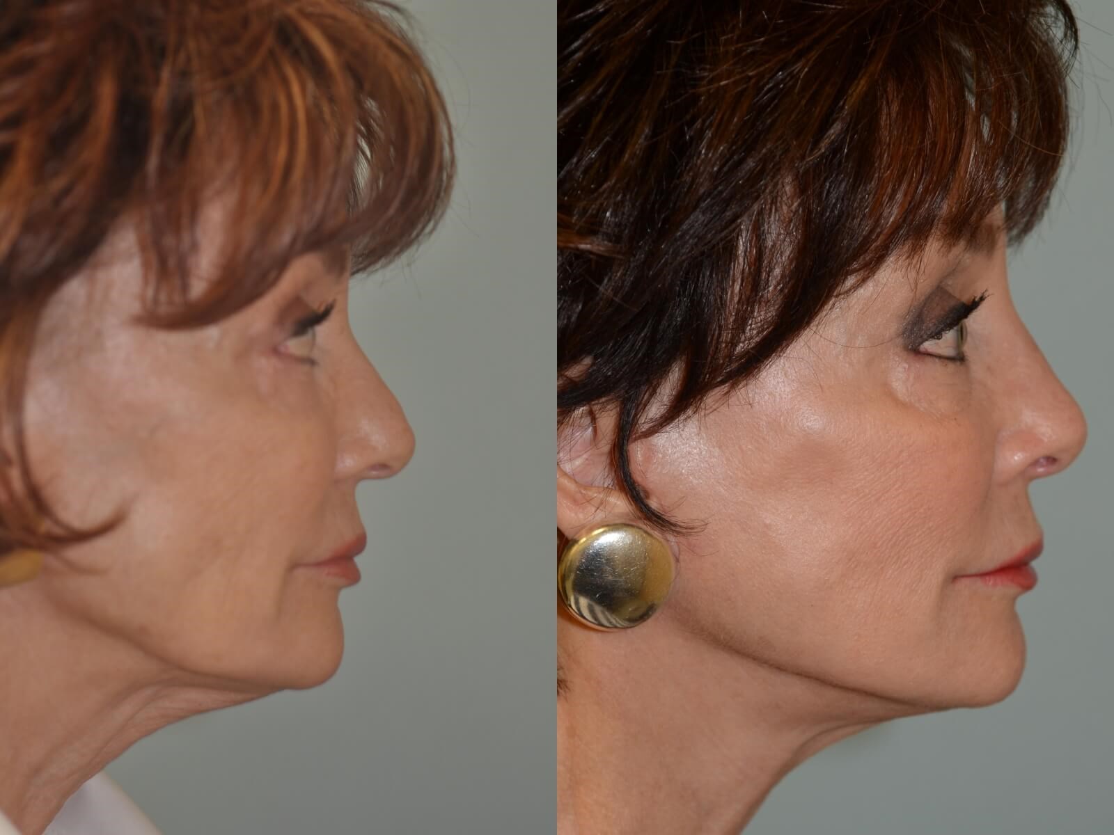 Rhinoplasty Before and After