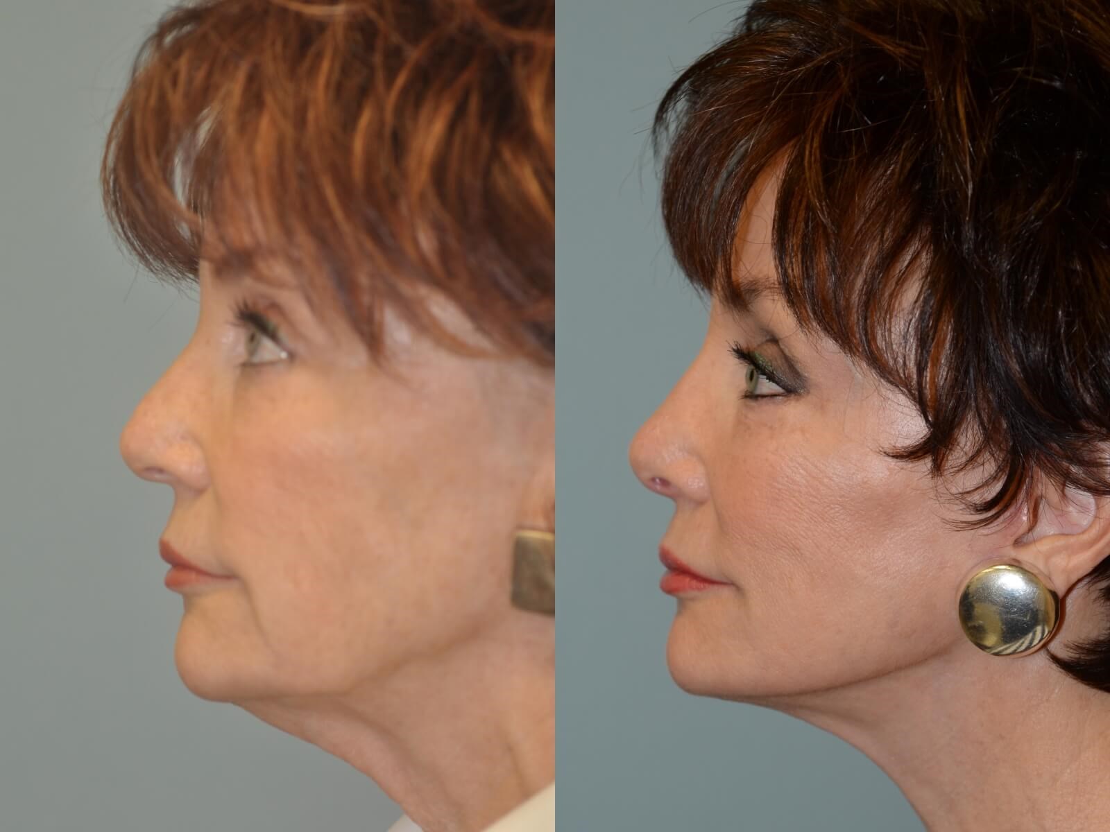Subtle Natural Rhinoplasty in Houston