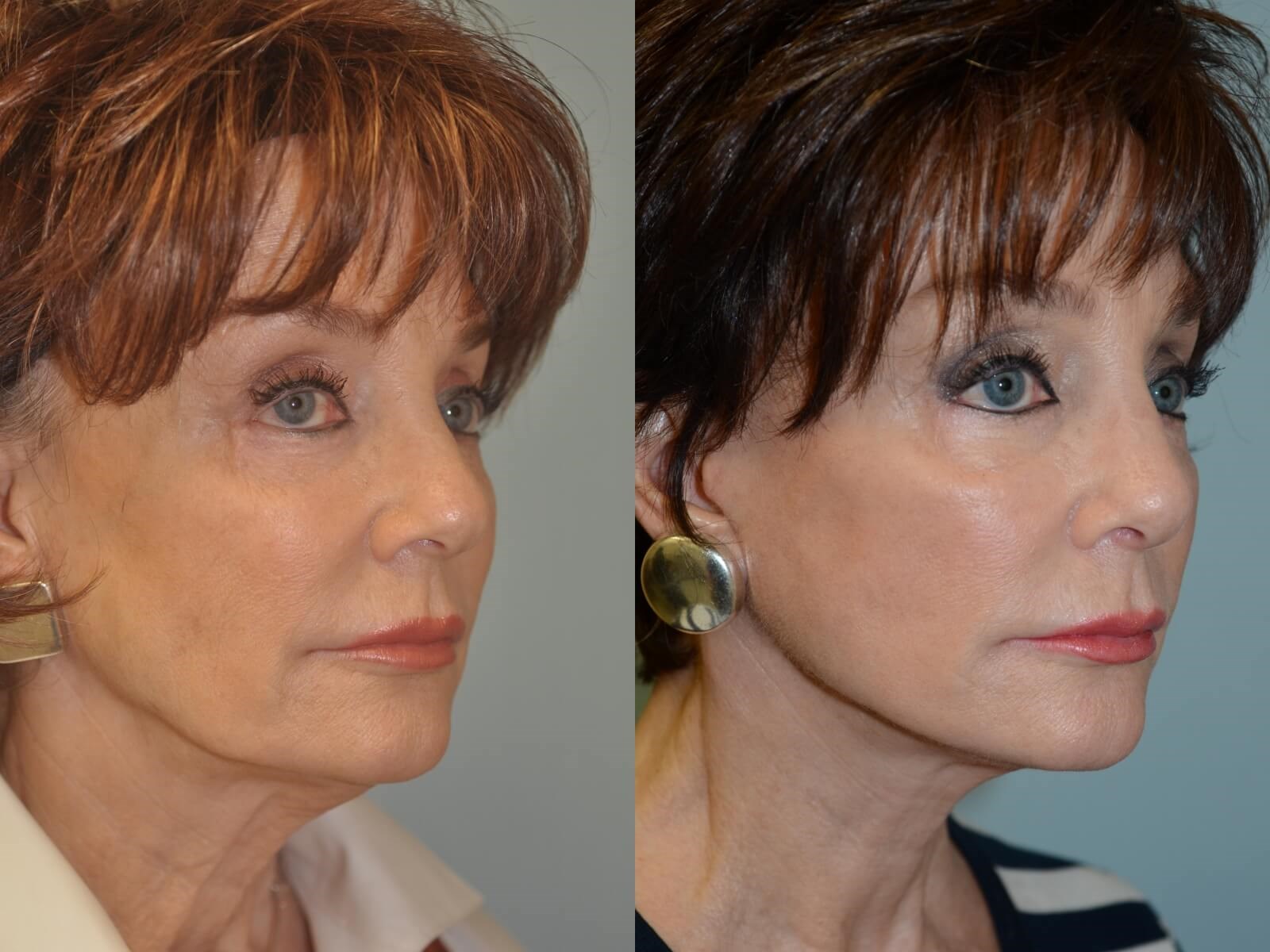 Subtle Natural Rhinoplasty in Houston