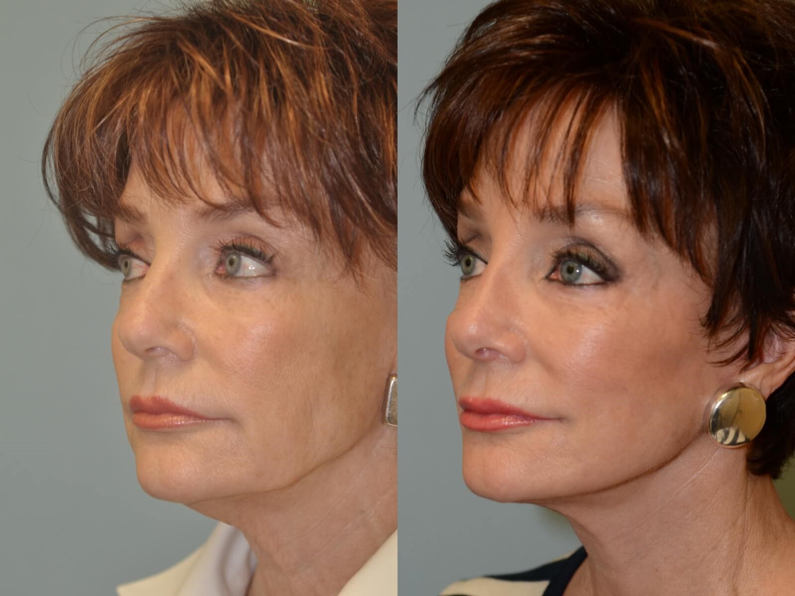 Subtle Natural Rhinoplasty in Houston