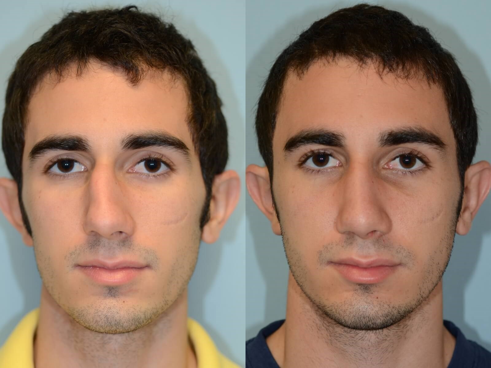 rhinoplasty Before and After