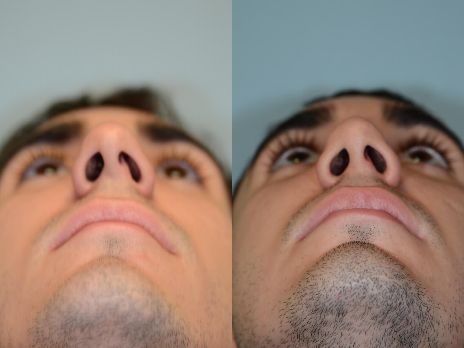 rhinoplasty Before and After