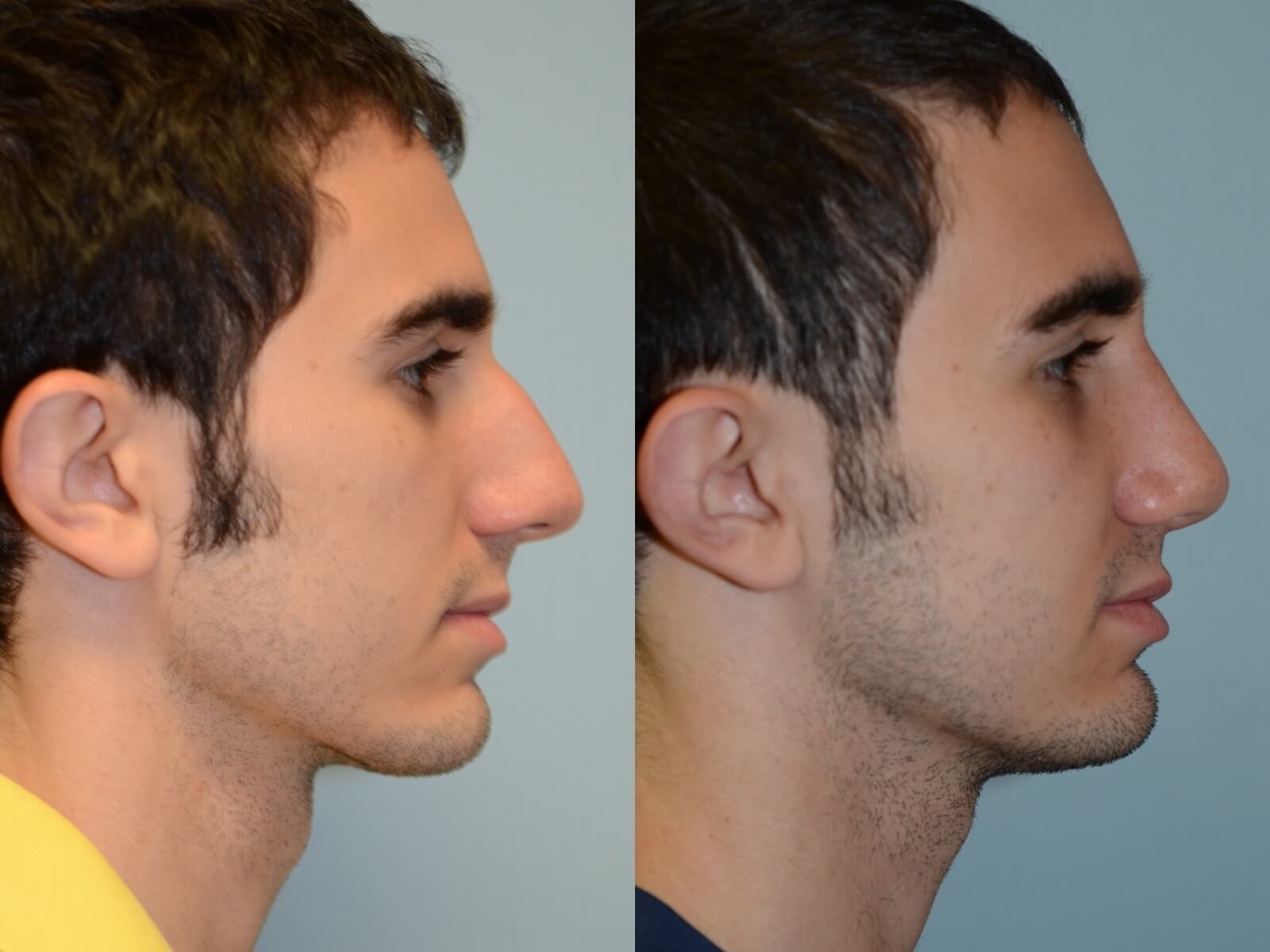 Rhinoplasty Before and After