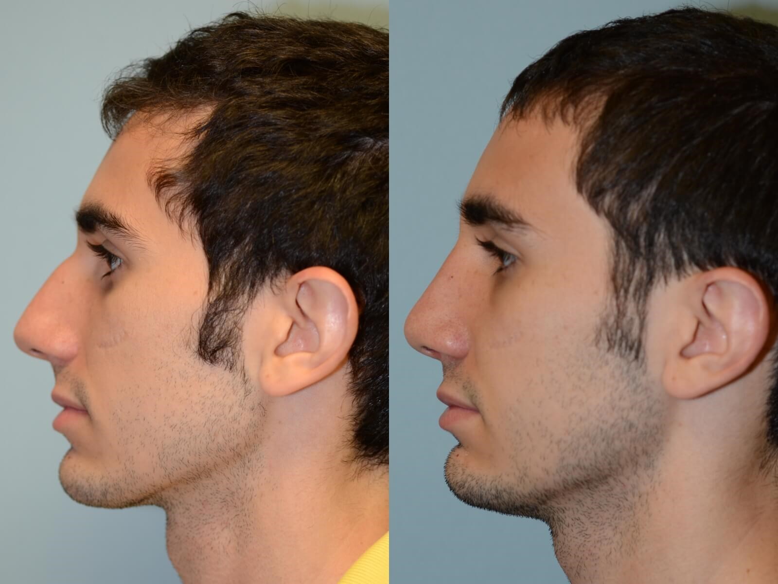 Rhinoplasty Before and After