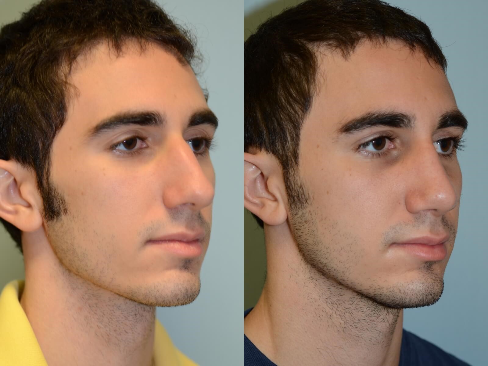 Rhinoplasty Before and After