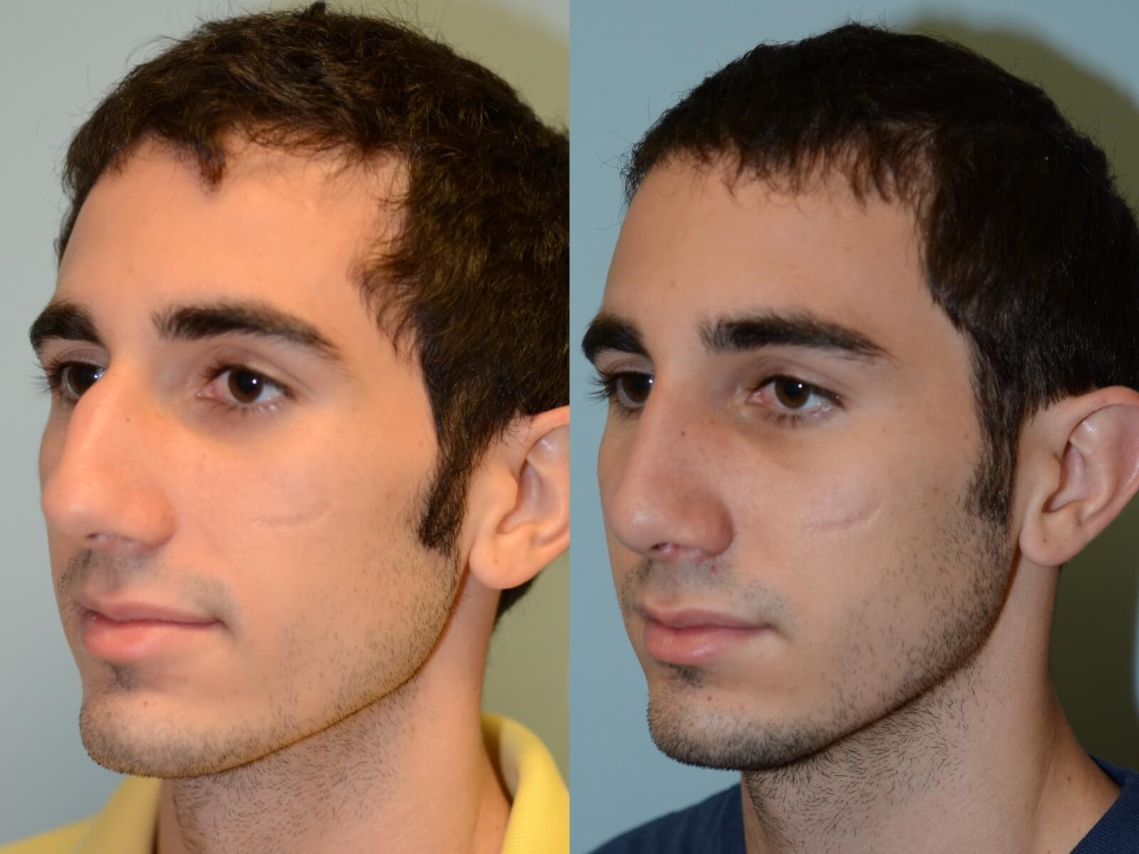 Rhinoplasty Before and After