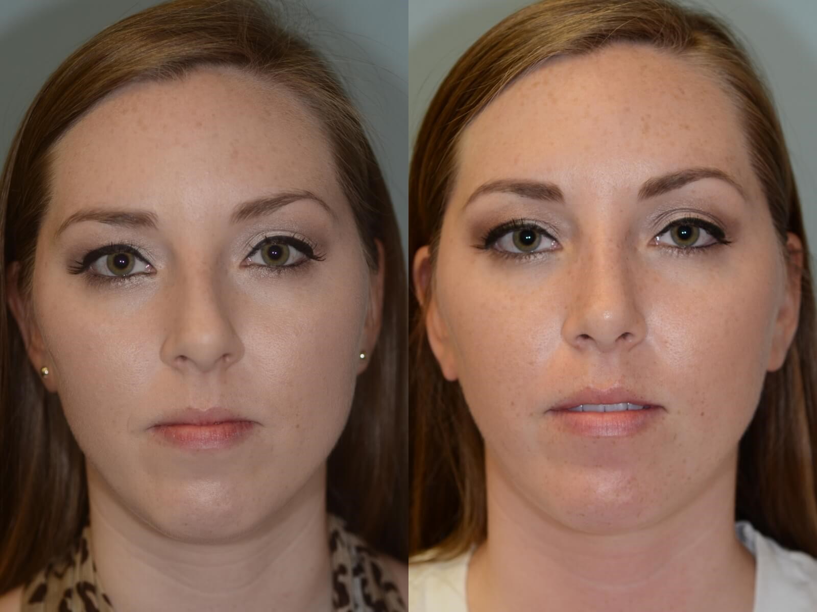 Rhinoplasty Before and After