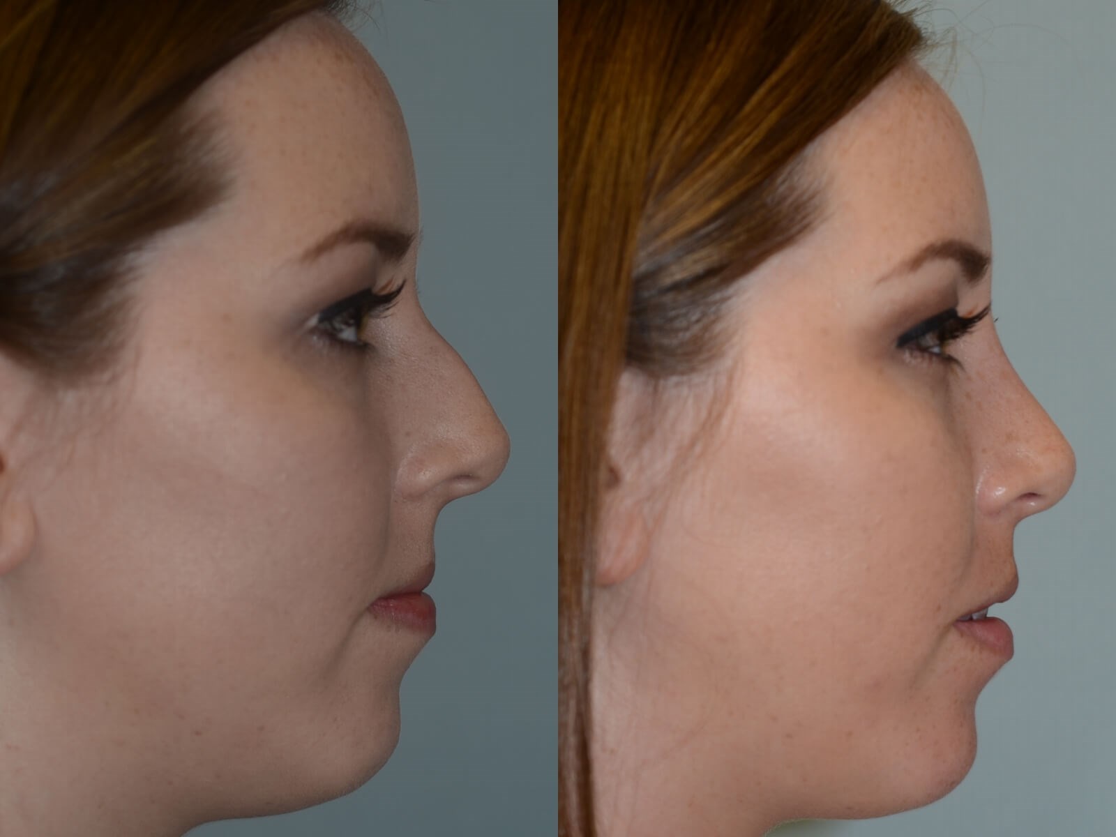 Rhinoplasty Before and After