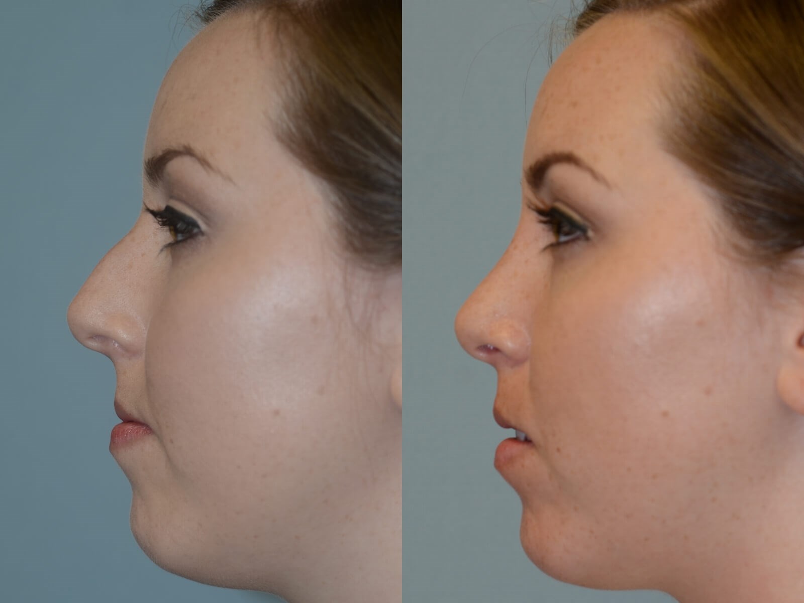 Rhinoplasty Before and After