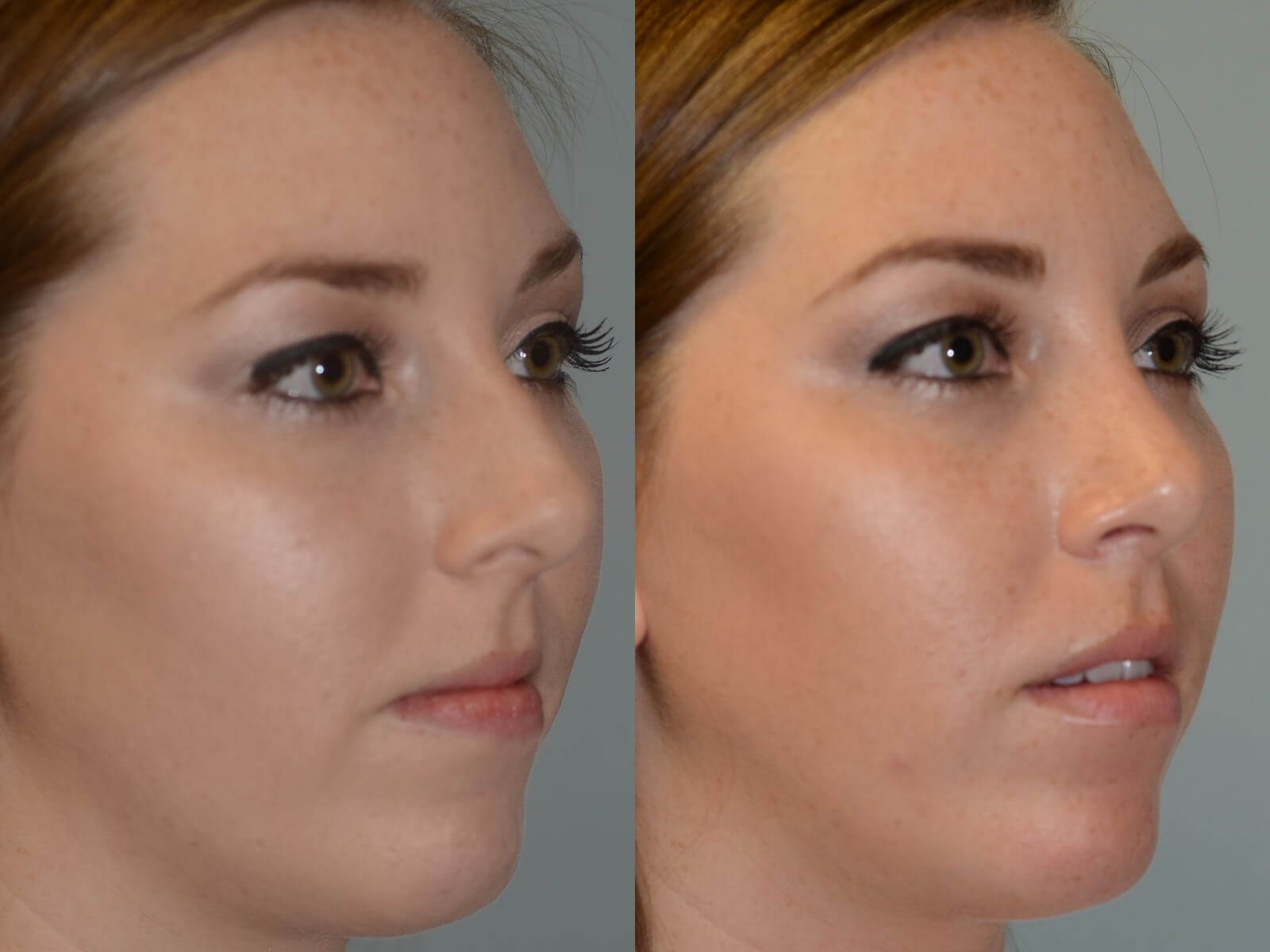 Rhinoplasty Before and After