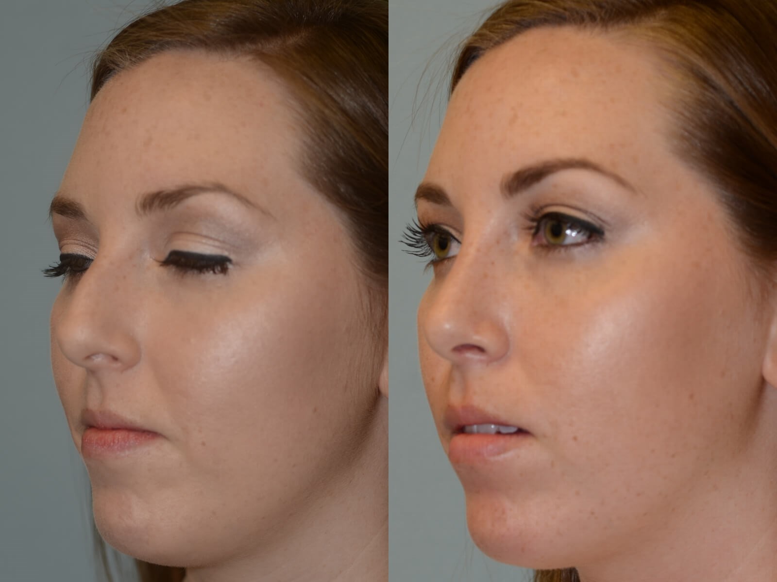 Rhinoplasty Before and After