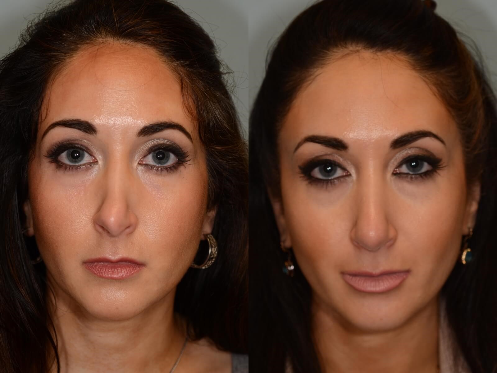 Rhinoplasty Before and After
