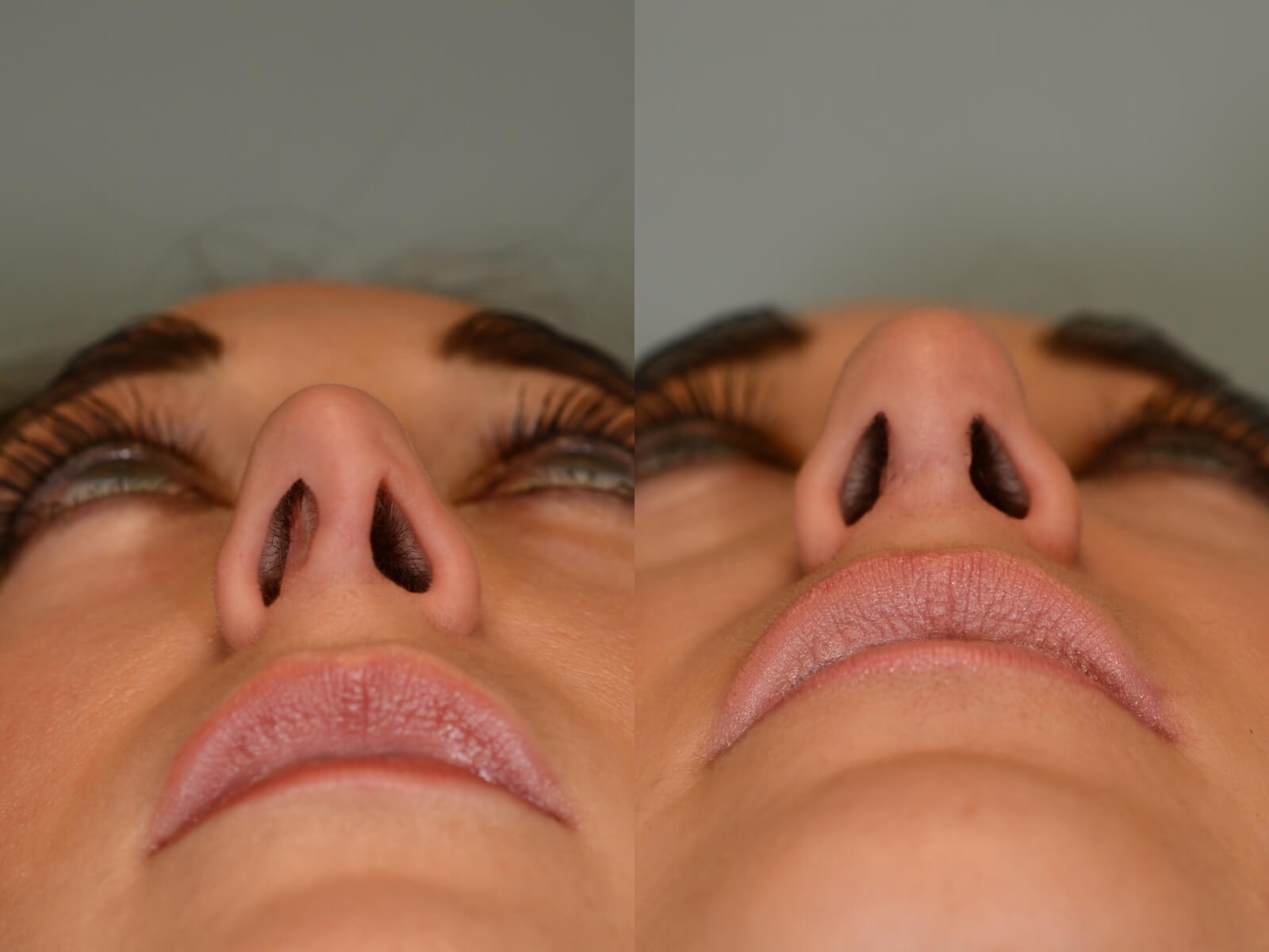 Rhinoplasty Before and After