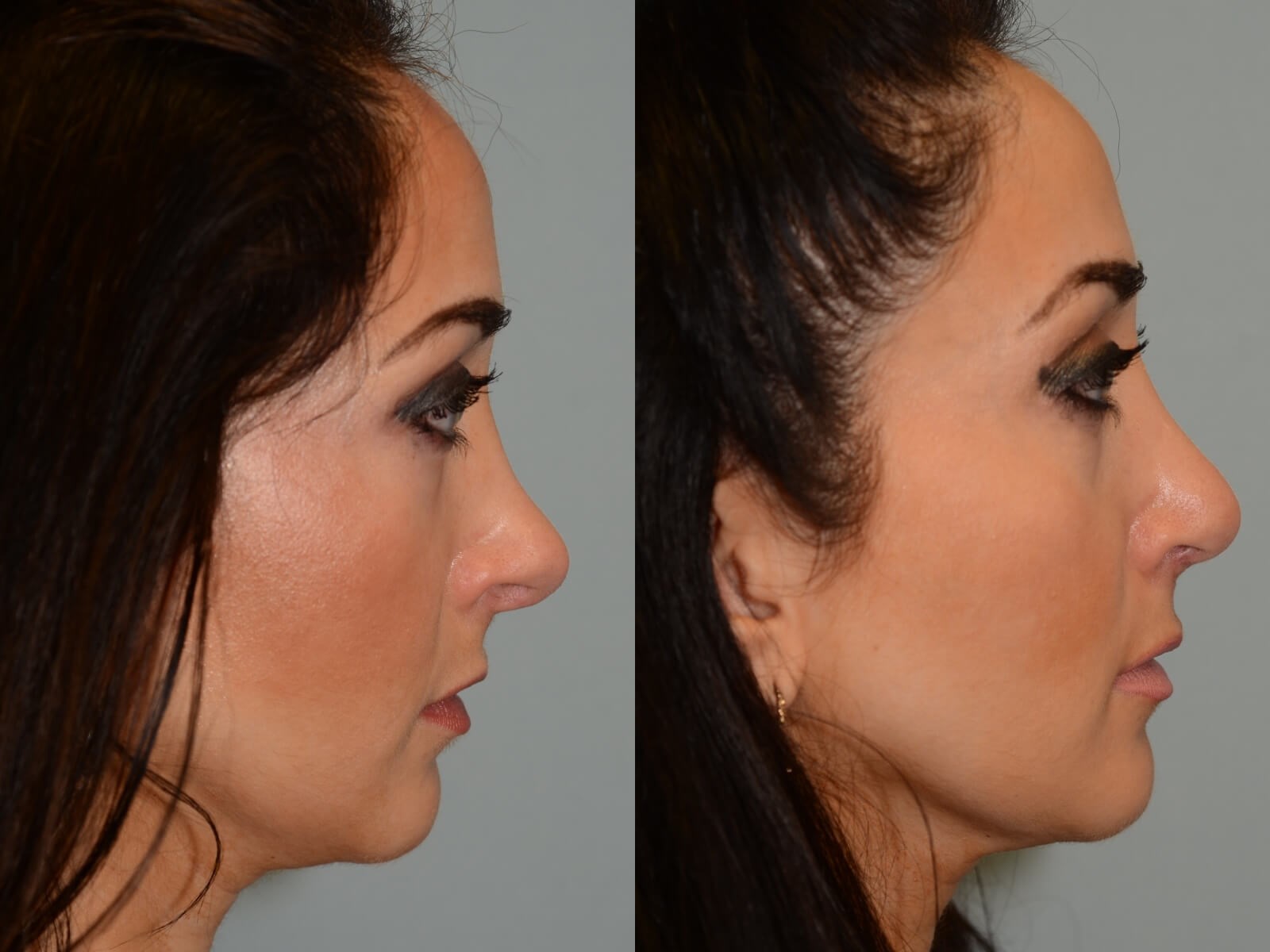 Rhinoplasty Before and After