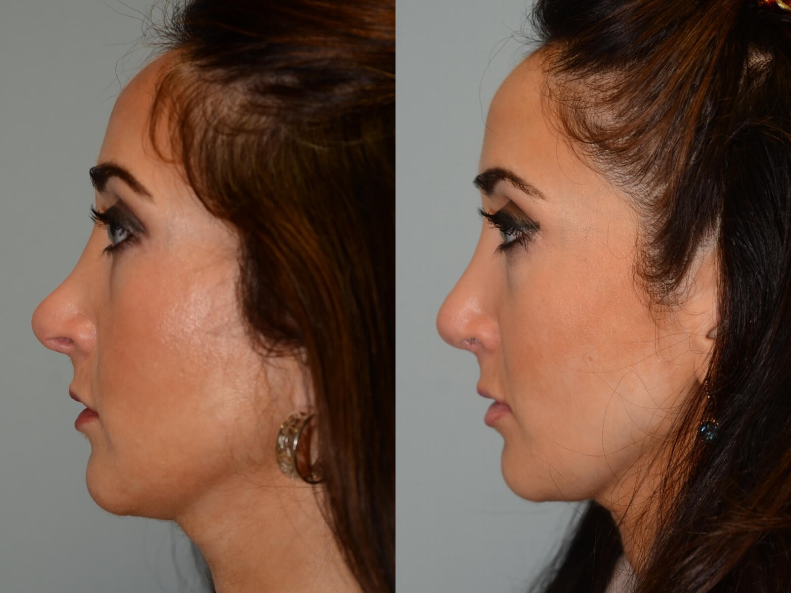 Rhinoplasty Before and After