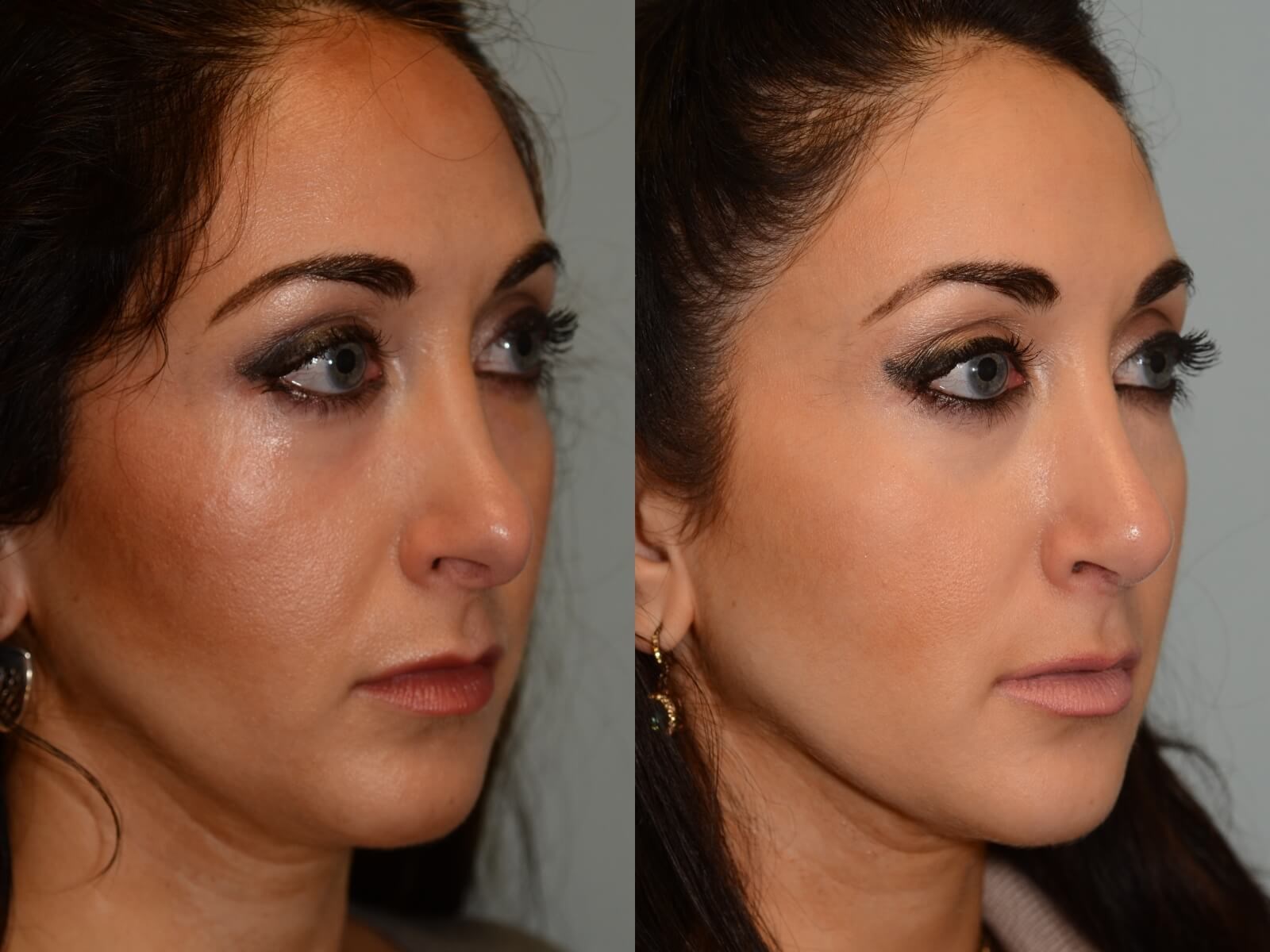 Rhinoplasty Before and After