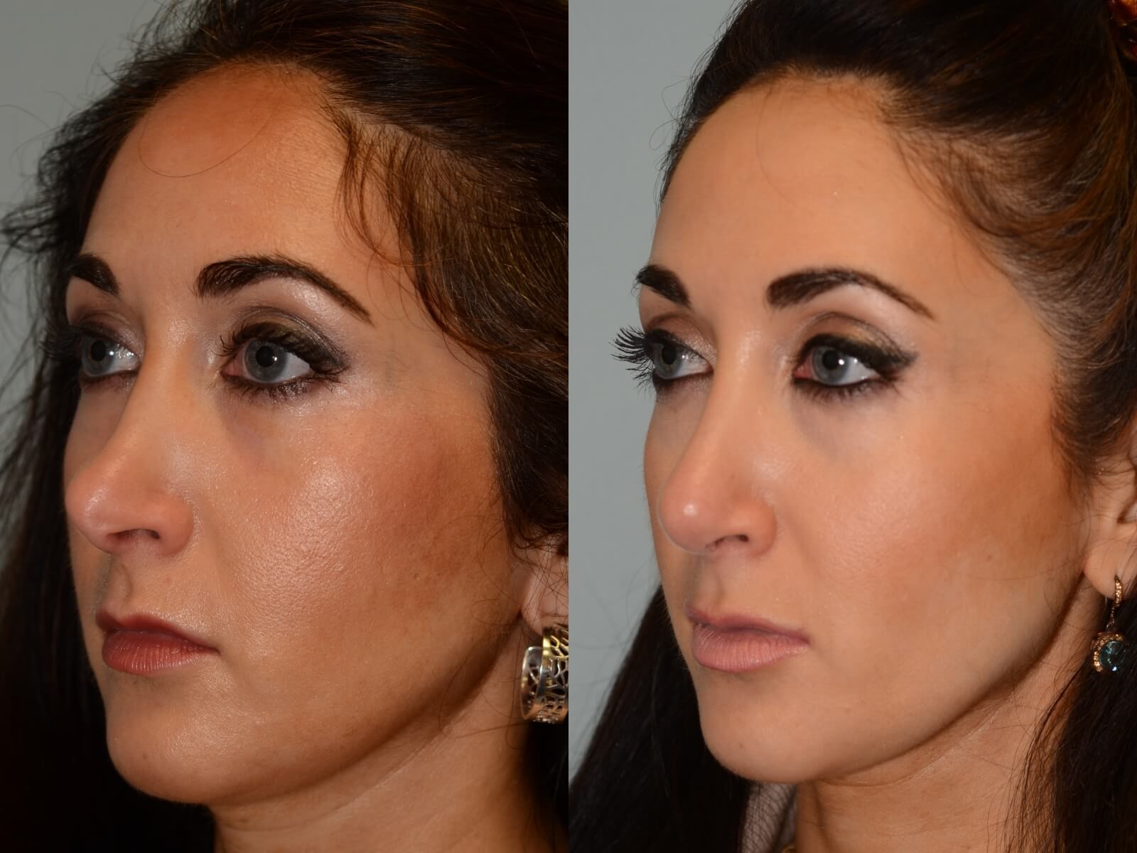 Rhinoplasty Before and After