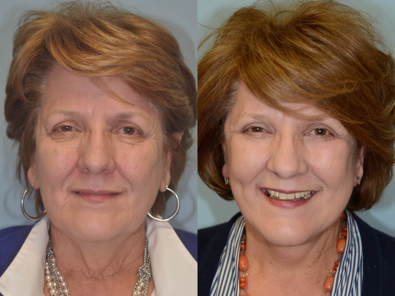 Looking more refreshed! Before and After
