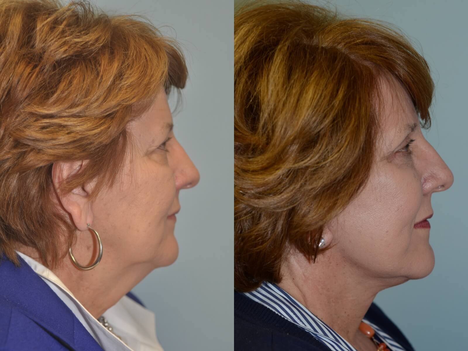 Smooth defined jawline Before and After
